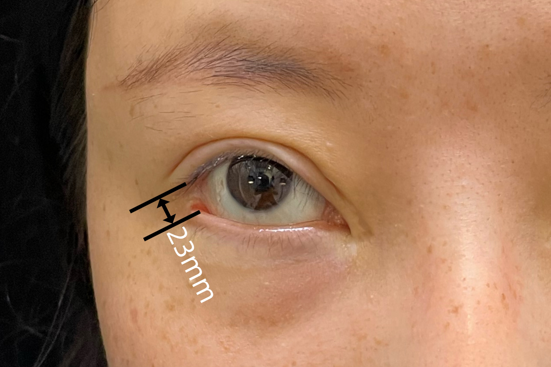 外眼角修复#  正常的眼睛,下睑缘是有个弧度,内外眼角处是往上走的