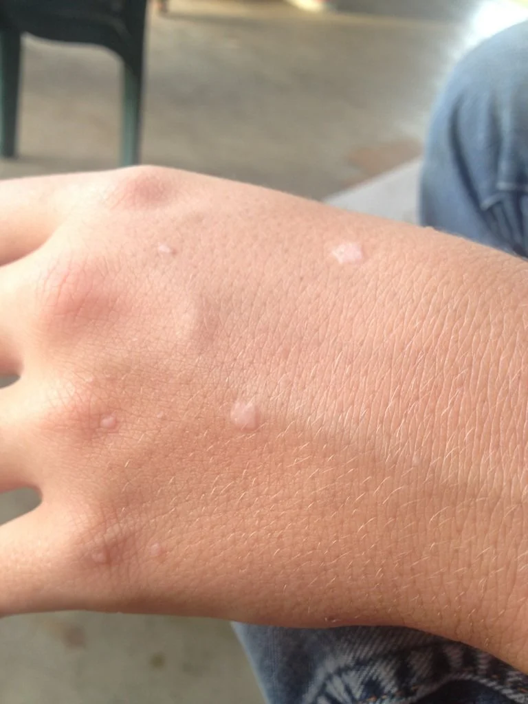 扁平疣,真的不是什么大问题:正确看待,轻松解决