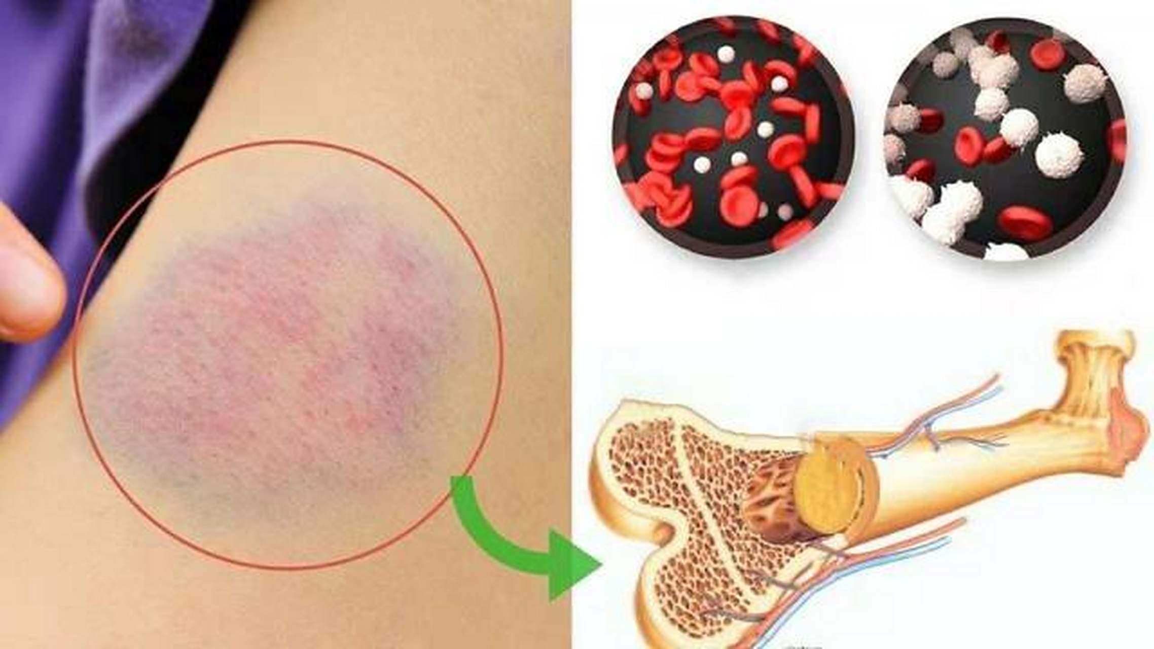 以下几种血液病的症状,告诉我你正在经历哪些    第一,白血病