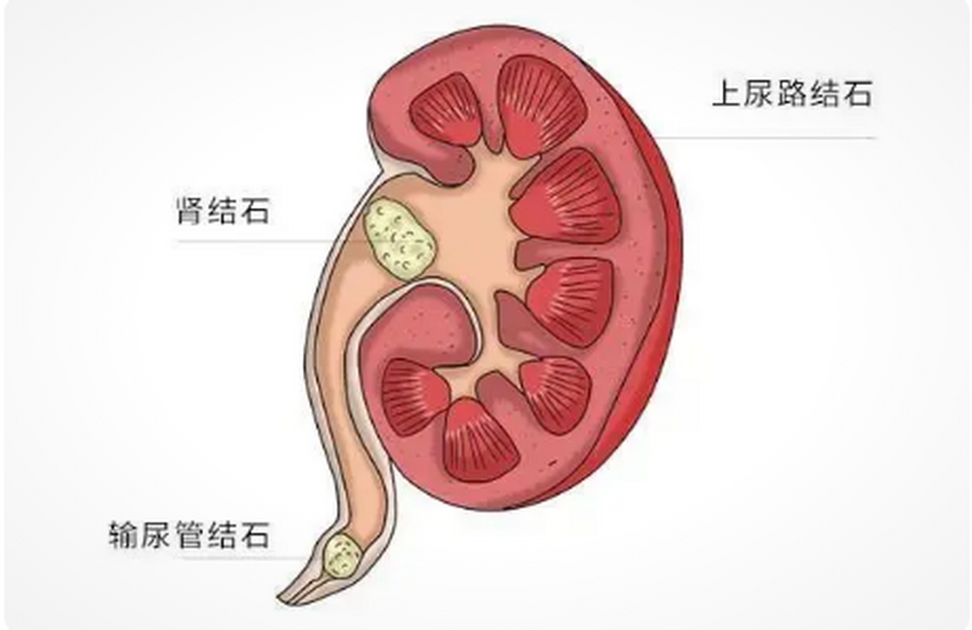 肾结石图片症状图片