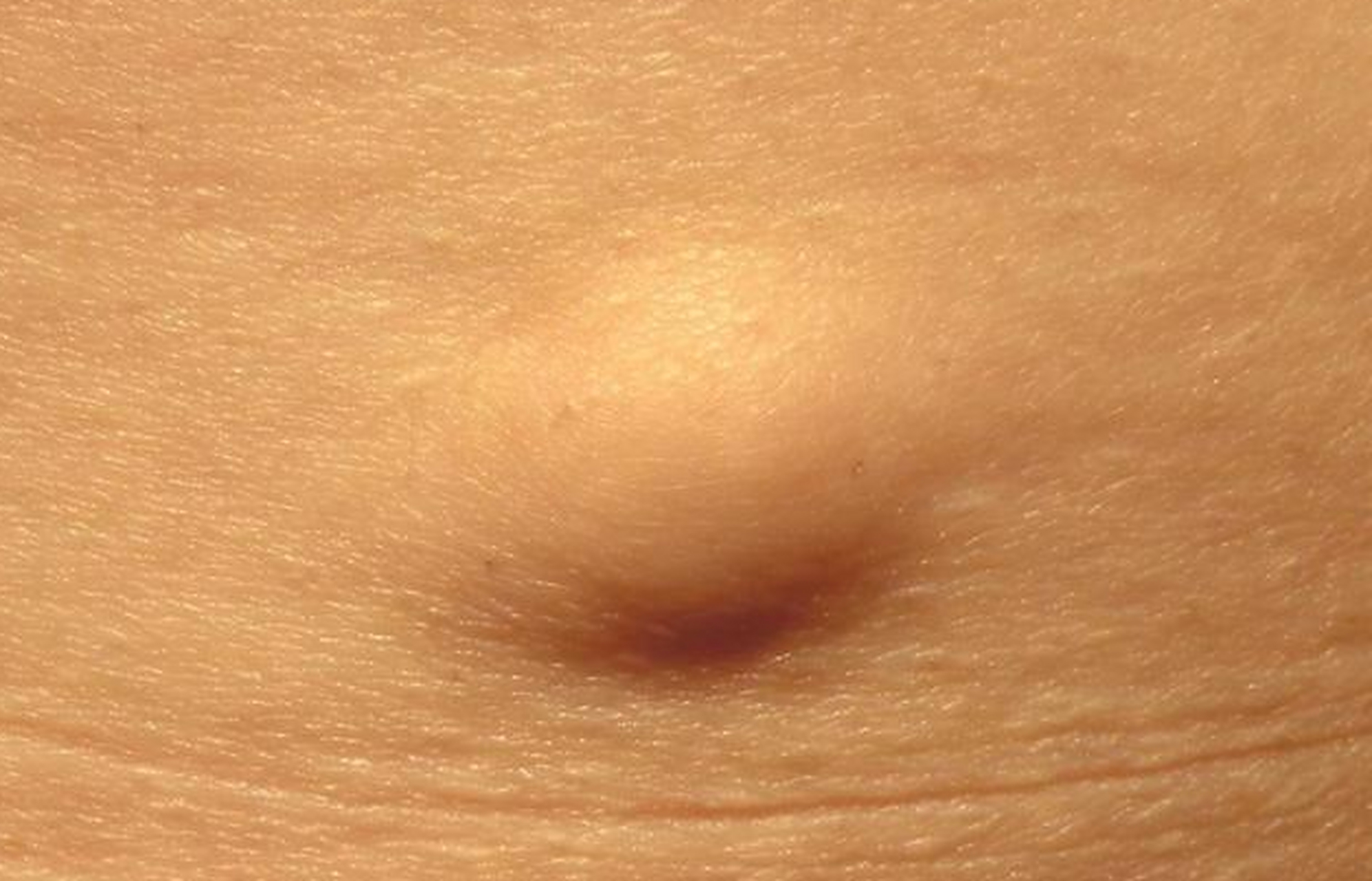 35岁女子,后背长了一个包块,洗澡的时候挠出血,到县医院检查,误诊脂肪