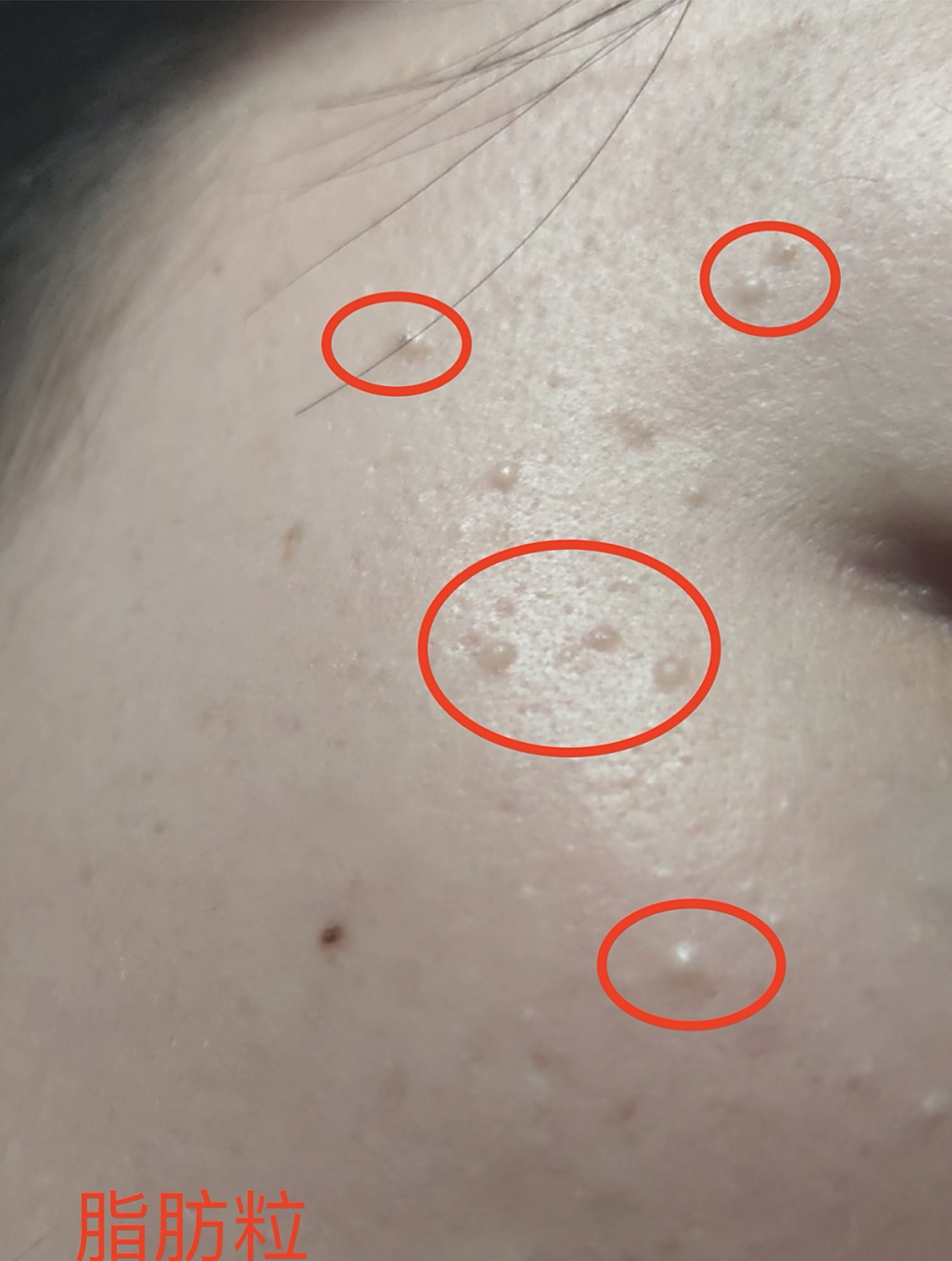 脸上的脂肪粒会自动消失吗?