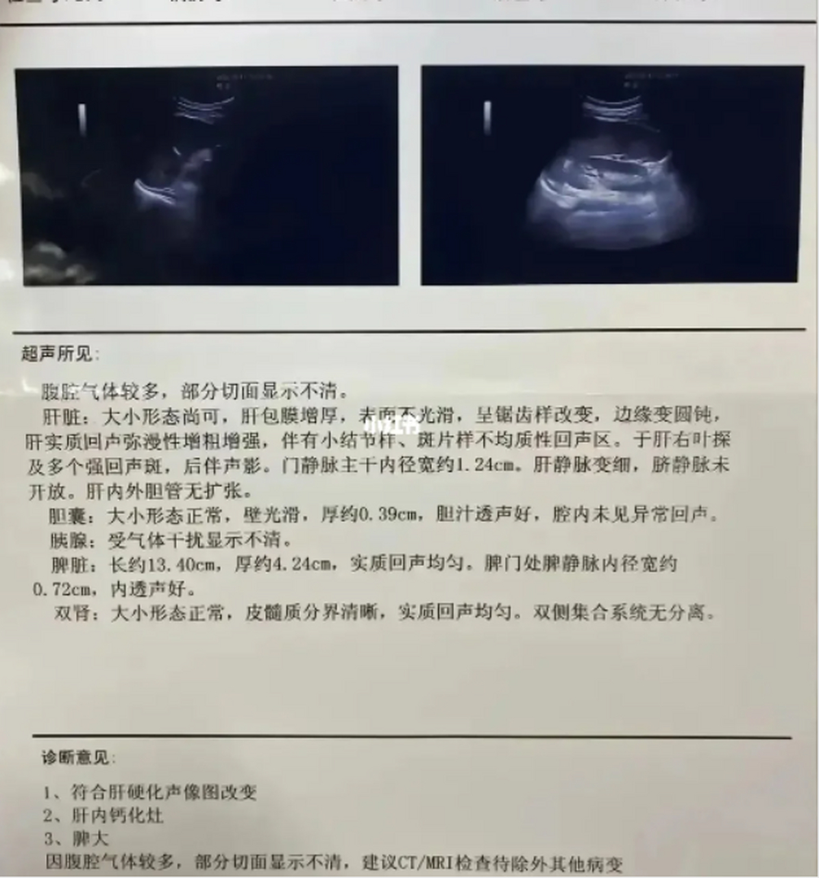 肝病是否严重,还要看肝功能在内的多项指标.