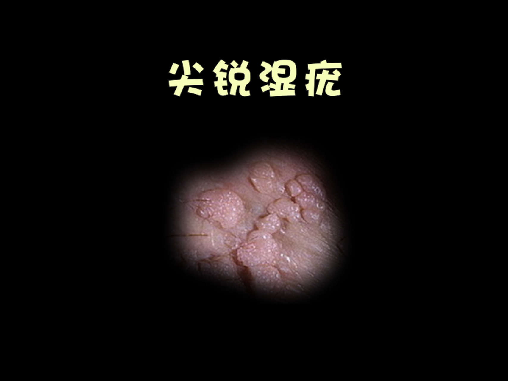 女性湿疣锐的简单介绍 女性湿疣锐的简单

先容
（女士湿锐疣） 女性