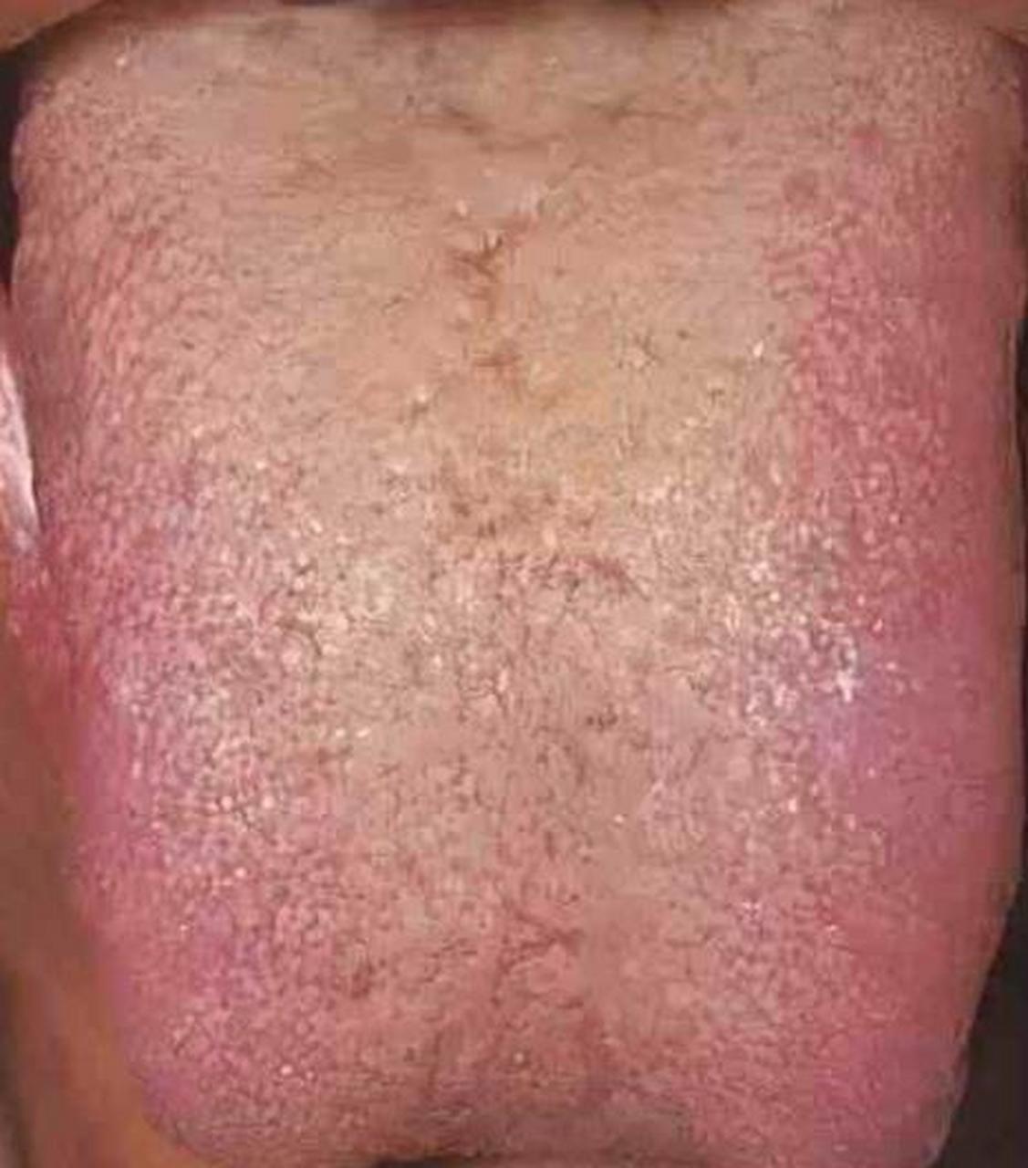 因为舌苔厚腻和体内水湿无法及时排泄出来有关,此时水分在体内滞留