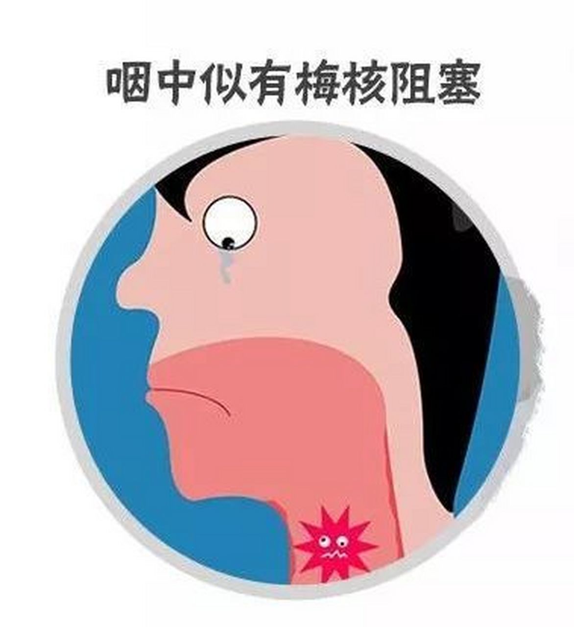 58岁河北张女士,咽炎梅核气案例分享  今天和大家分享一个咽炎梅核气