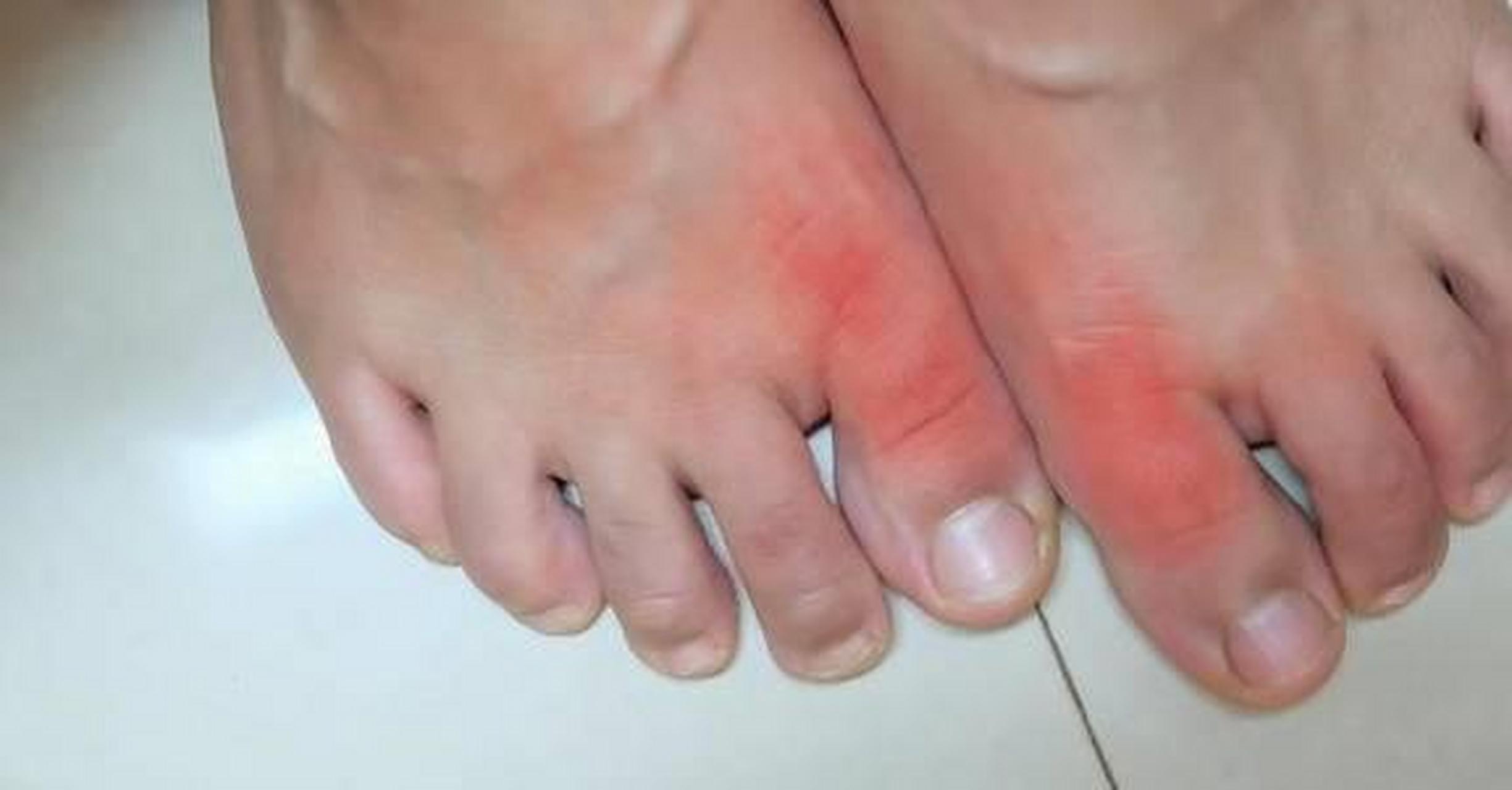 痛风石常见于痛风和高尿酸血症患者,由于尿酸盐结晶在软组织沉积,产生