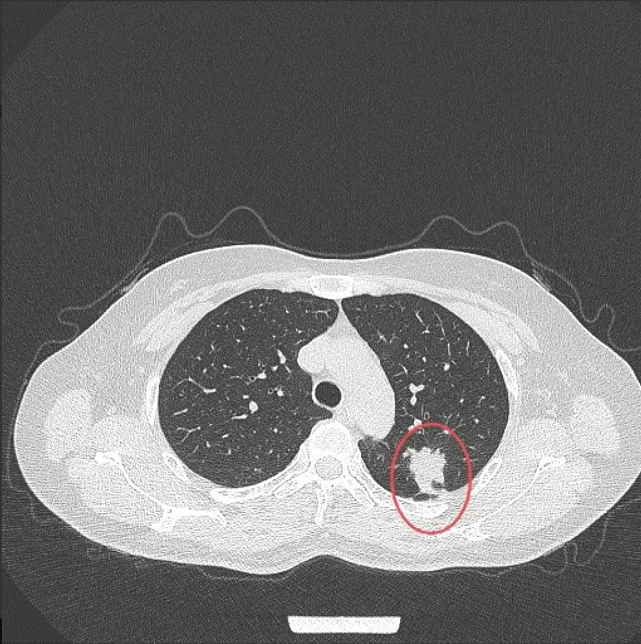 8厘米肺癌,4枚淋巴结转移 这位女士50多岁,不抽烟, 因为胸疼做ct检查