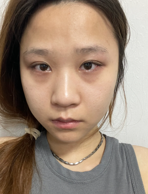 黑眼圈是很多人面临的困扰,而黑眼圈的形成原因有很多种.