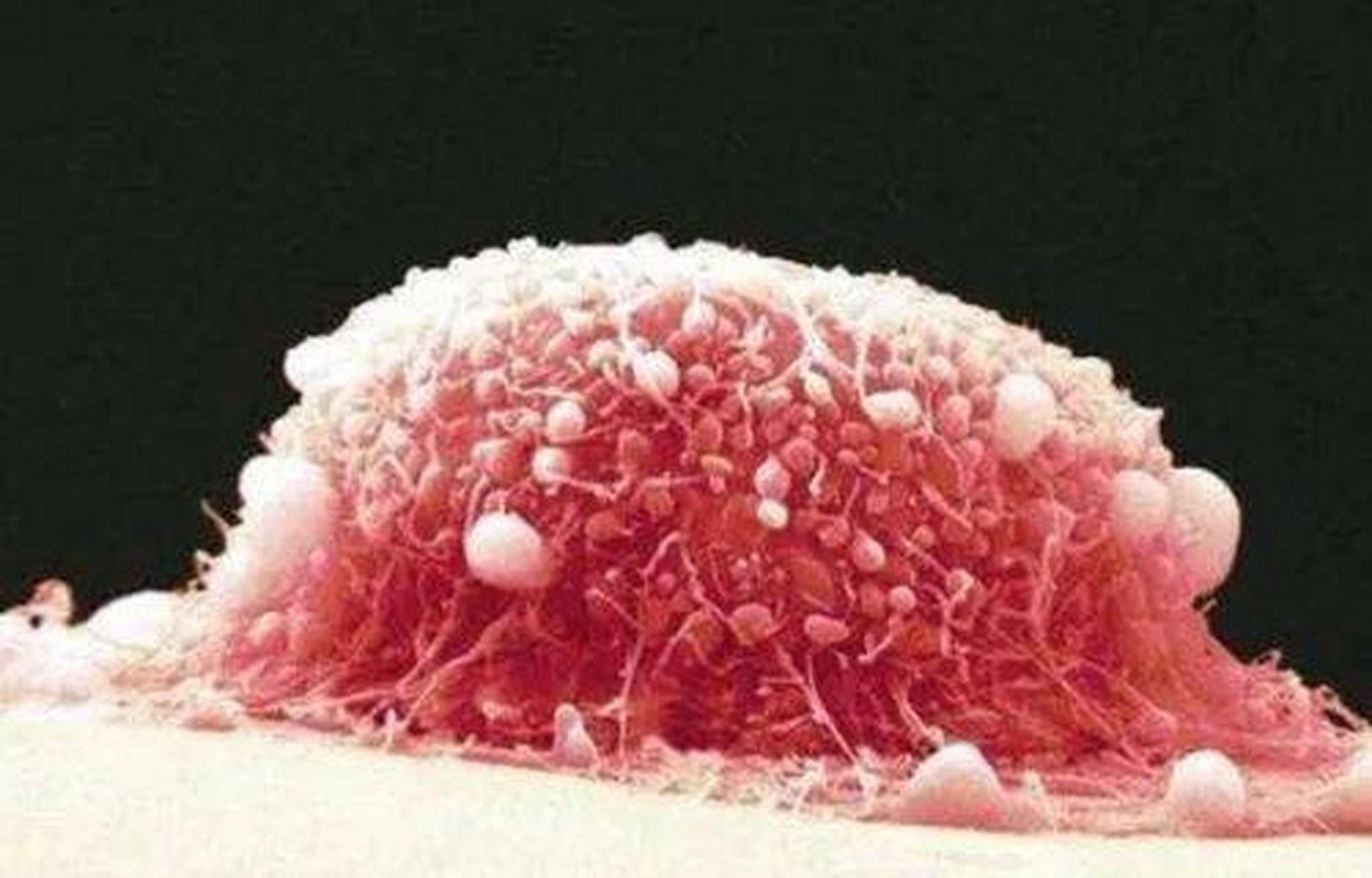 【性病】冠状沟尖锐湿疣的初期症状:  1,细小淡红色丘疹,后逐渐增大