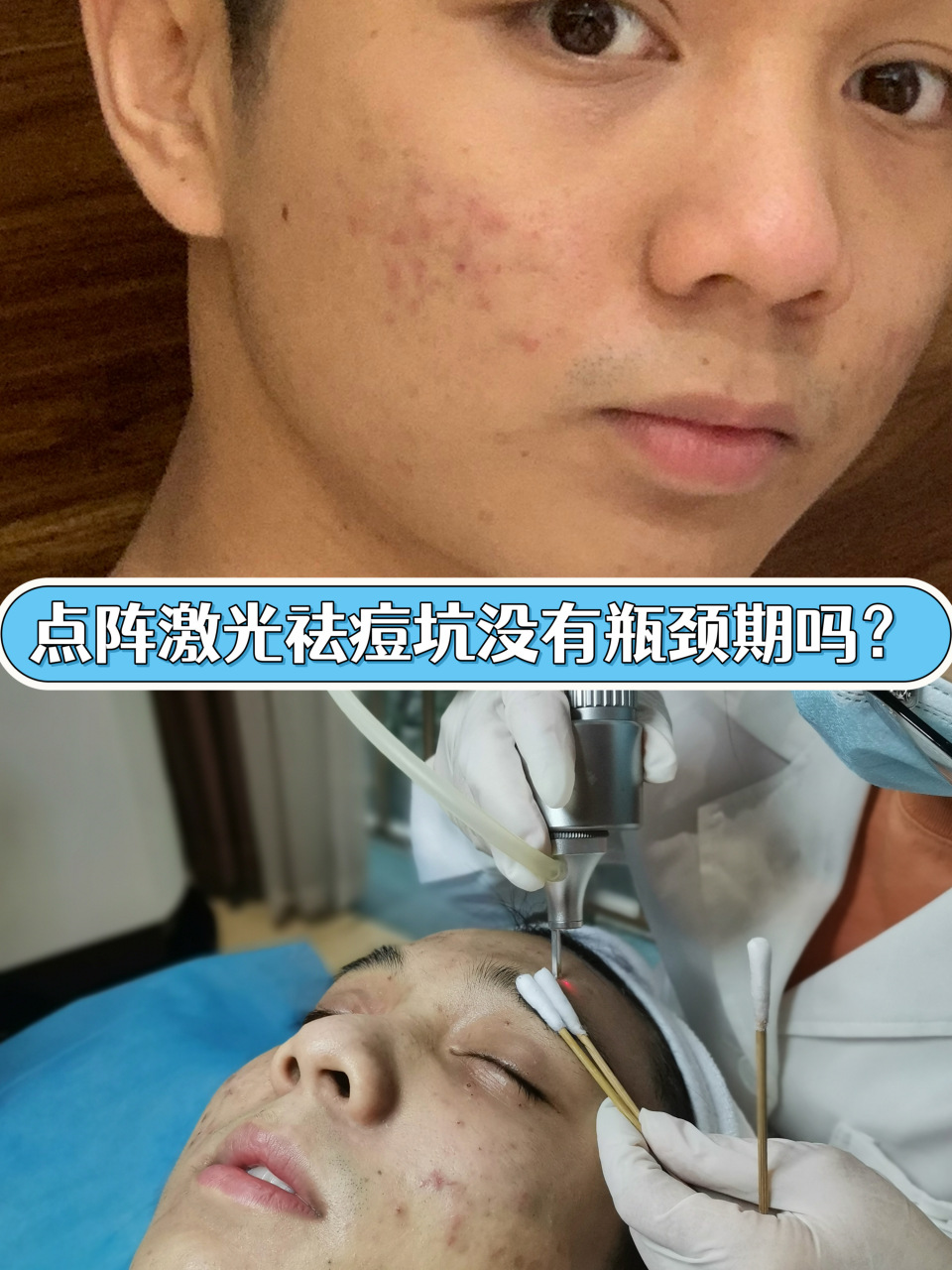 点阵激光祛痘坑没有瓶颈期吗?