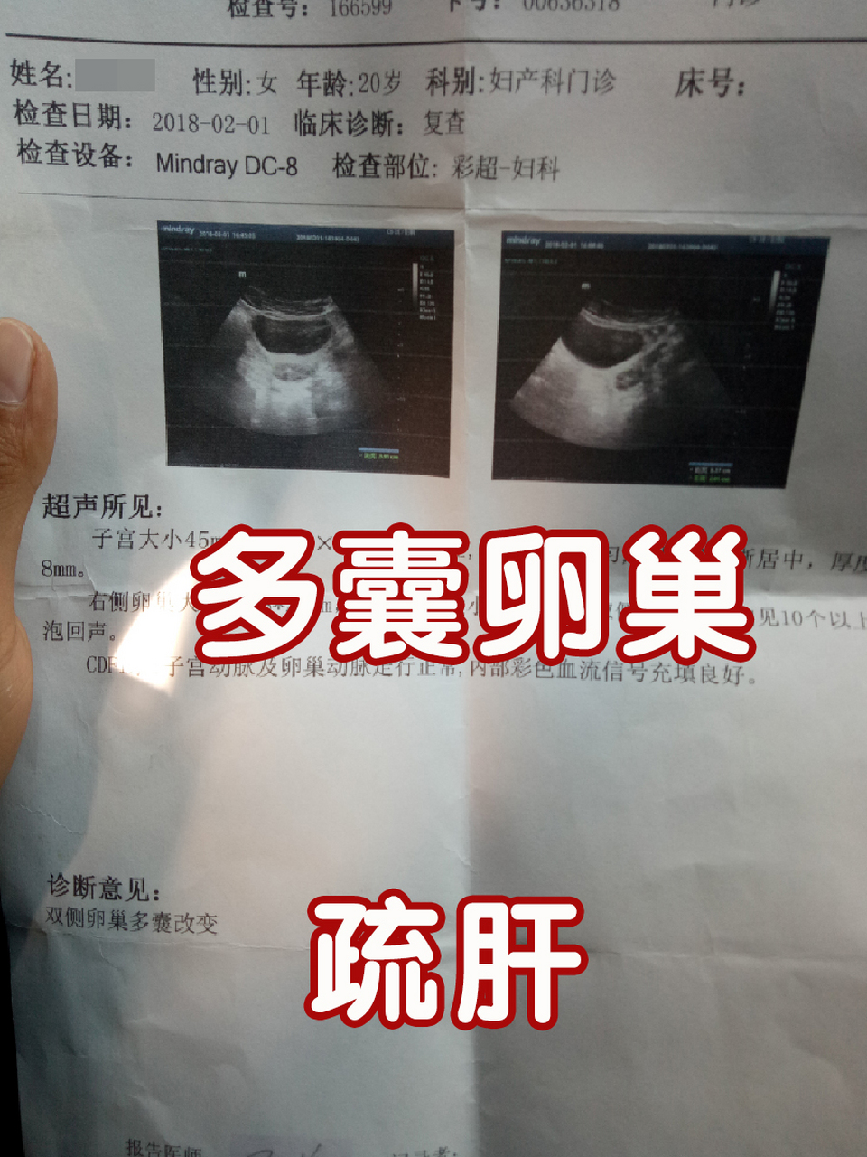 卵巢囊肿,疏肝 我的一位患者,卵巢囊肿5.