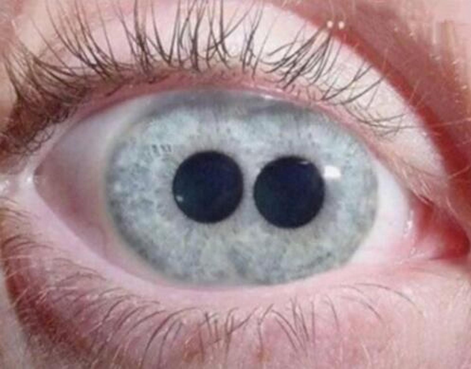 双瞳孔是一种极为罕见的情况,即一个人的一只眼睛里有两个瞳孔.