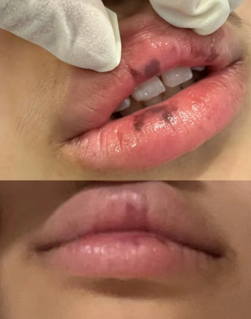 那么,我们该如何去除嘴唇上的黑斑呢?本文将为您介绍几种有效的方法.