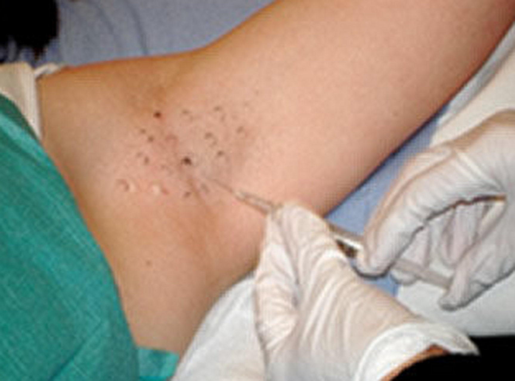 注射去狐臭能维持多久呢?