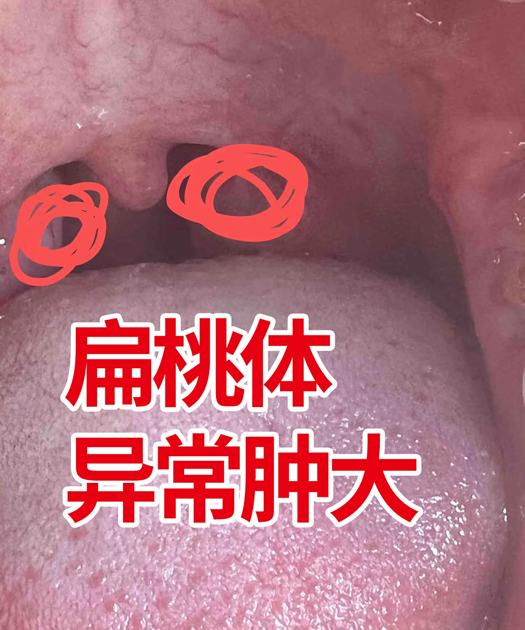 扁桃体单侧的肿大,我话说在前头,一发现就要尽快就医,等不得!