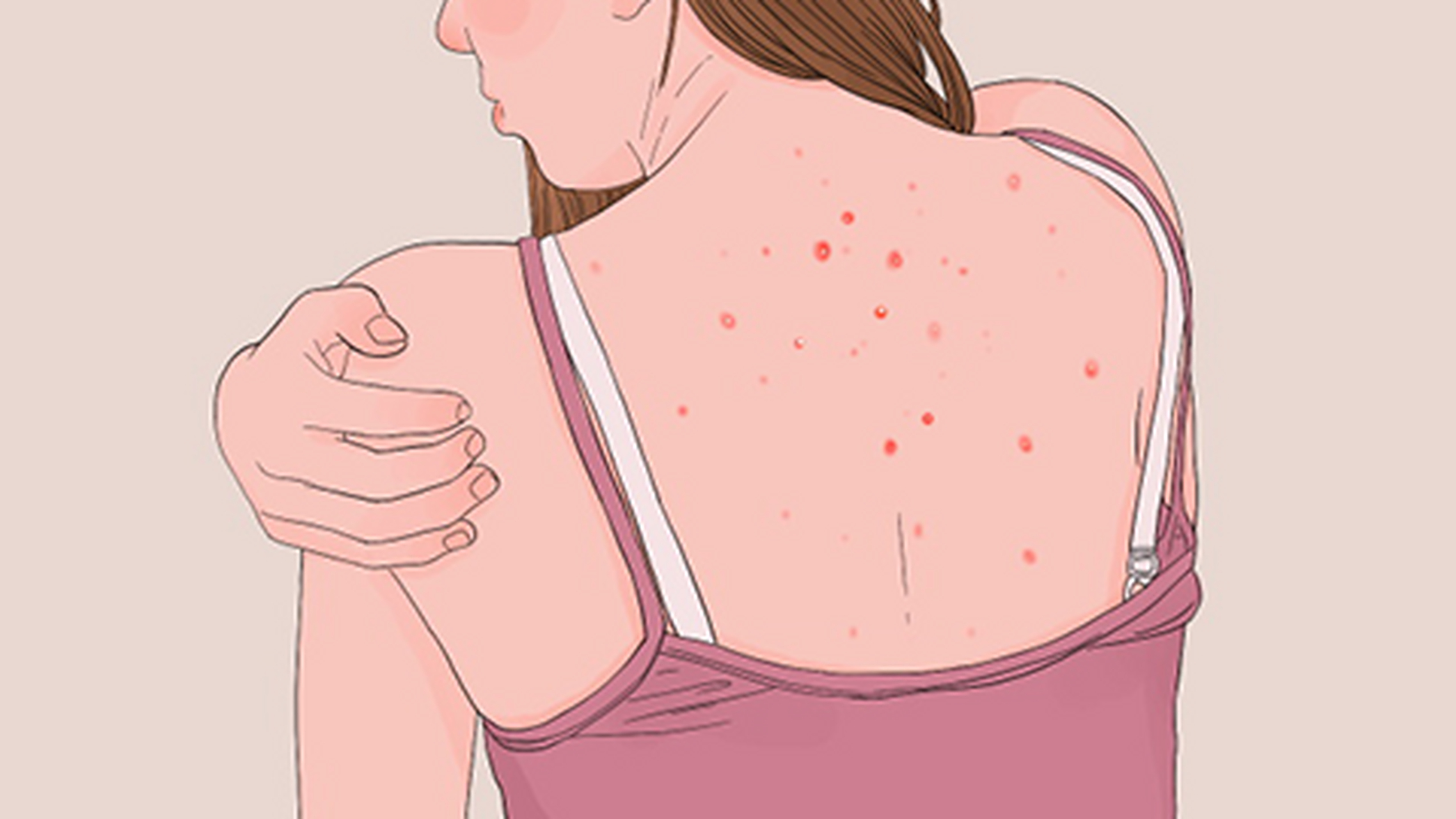 痘痘# #祛痘# #毛囊炎# #南京看毛囊炎好的医院#  ① 夏天天气炎热