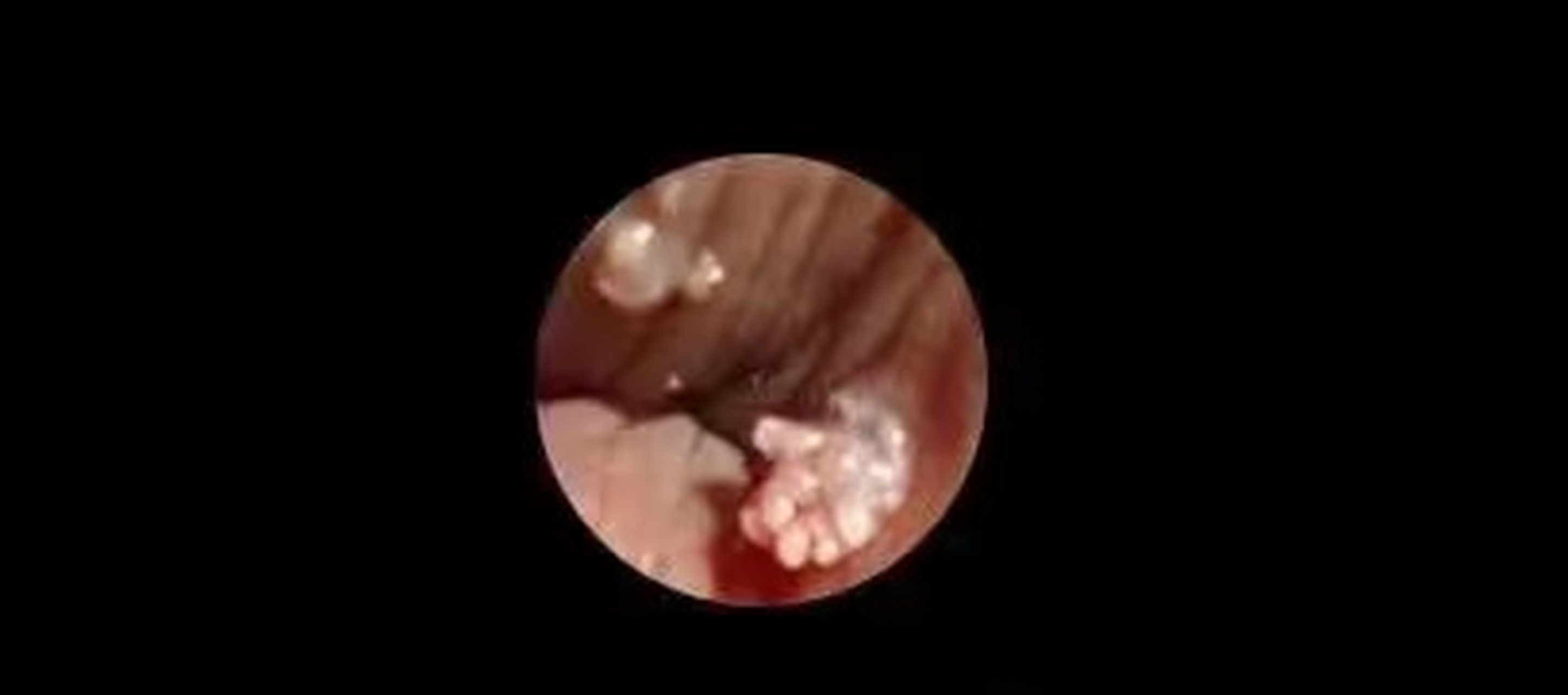 对于典型的菜花状,鸡冠状或乳头状的#尖锐湿疣# 临床表现,经验丰富的