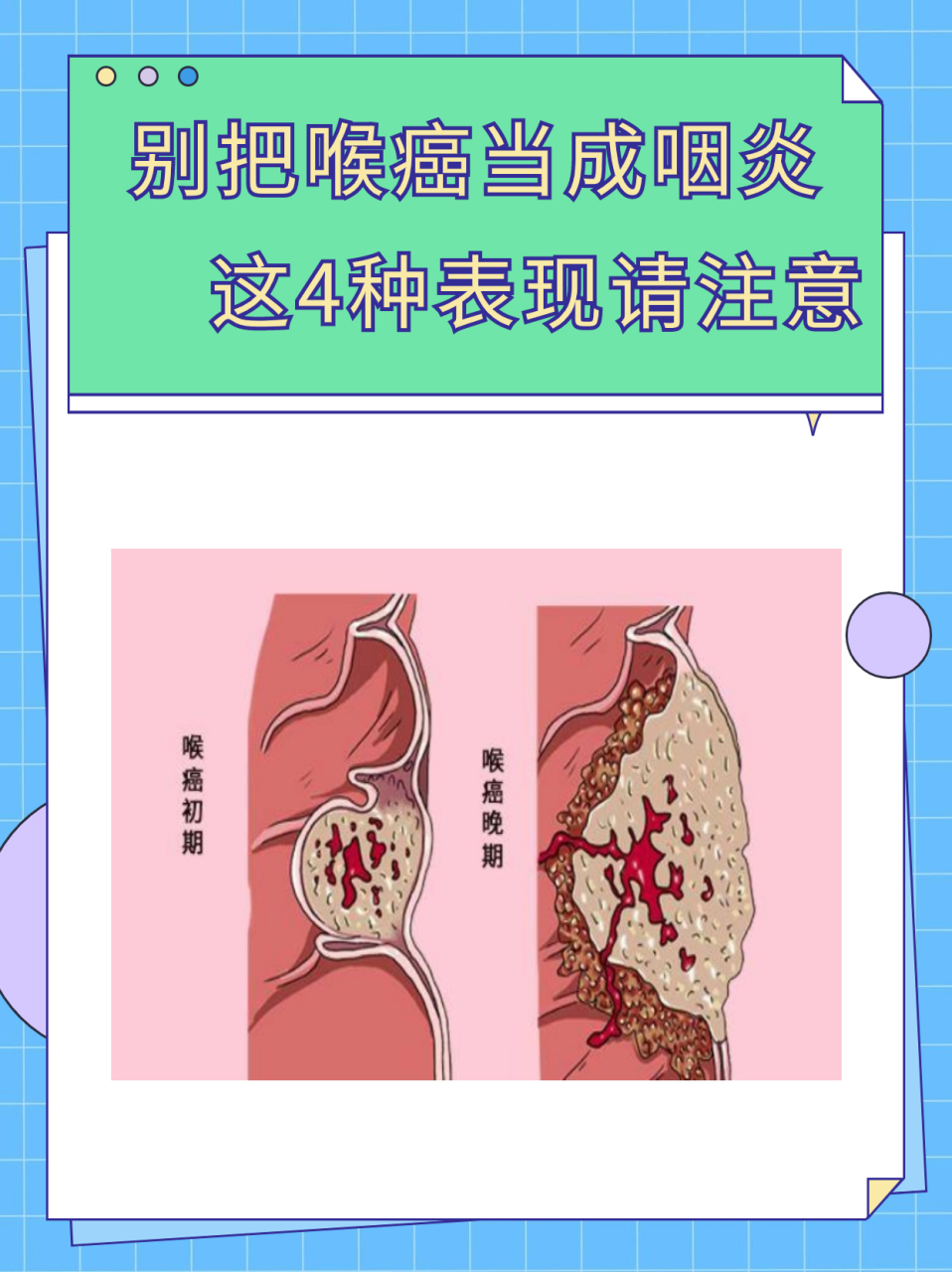 喉癌和咽炎的区别图片图片