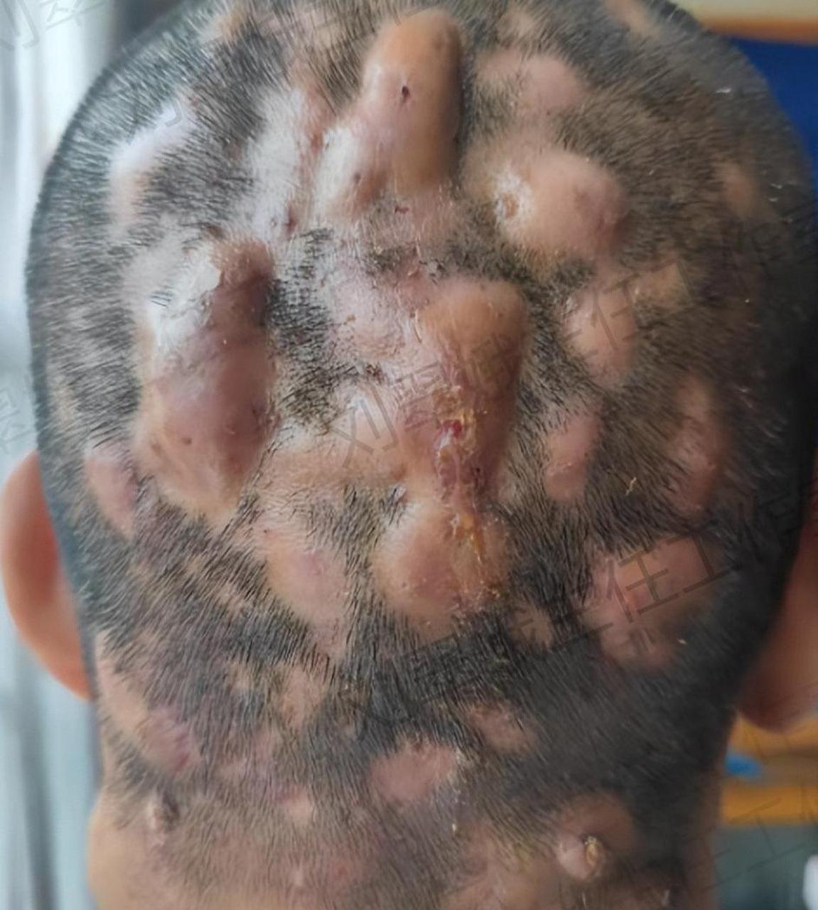 头上长脓包10年,中医辨证治疗2个月,脓包小了,长出新的头发茬!