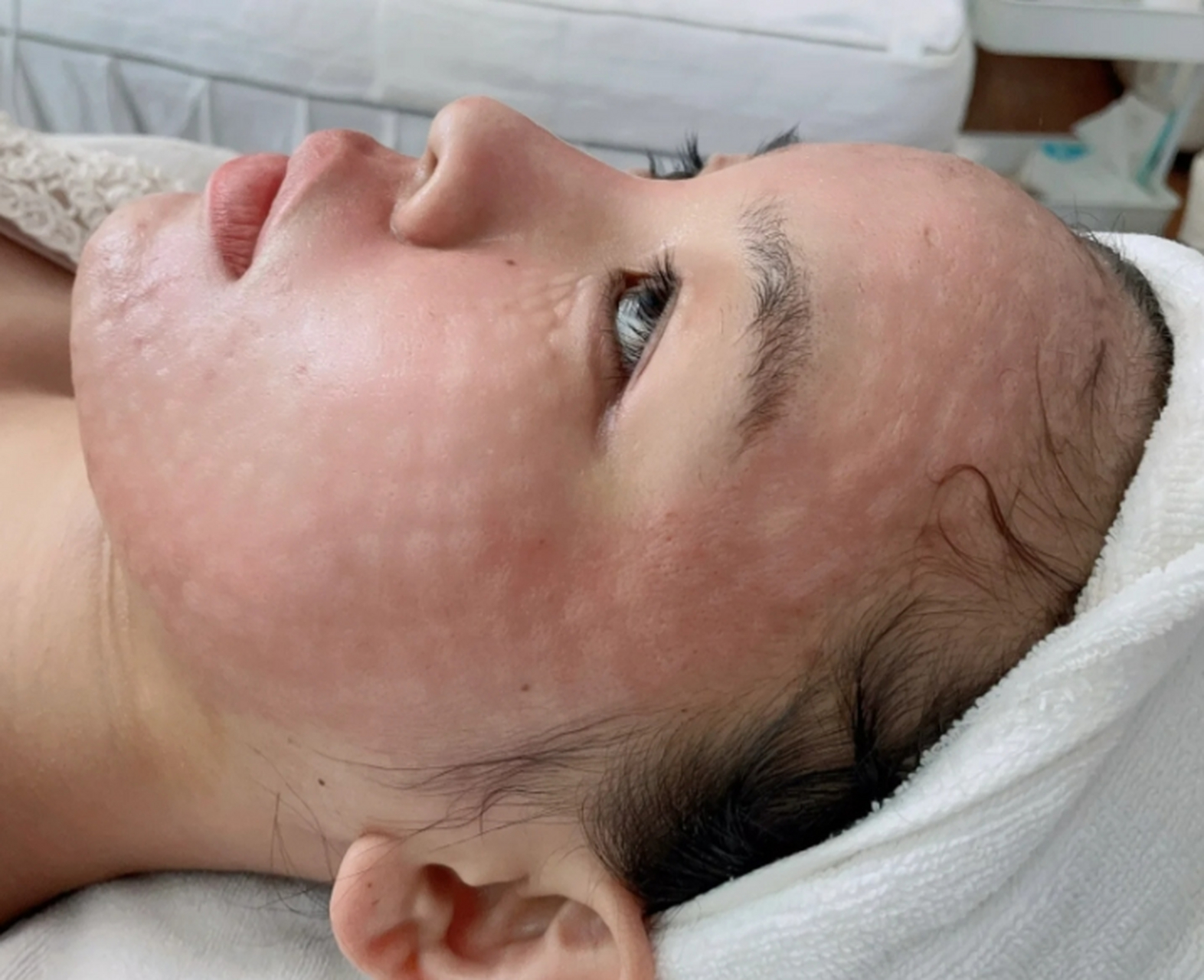 水光针是一种非手术美容治疗,常用于改善面部肌肤的光泽和保湿效果.