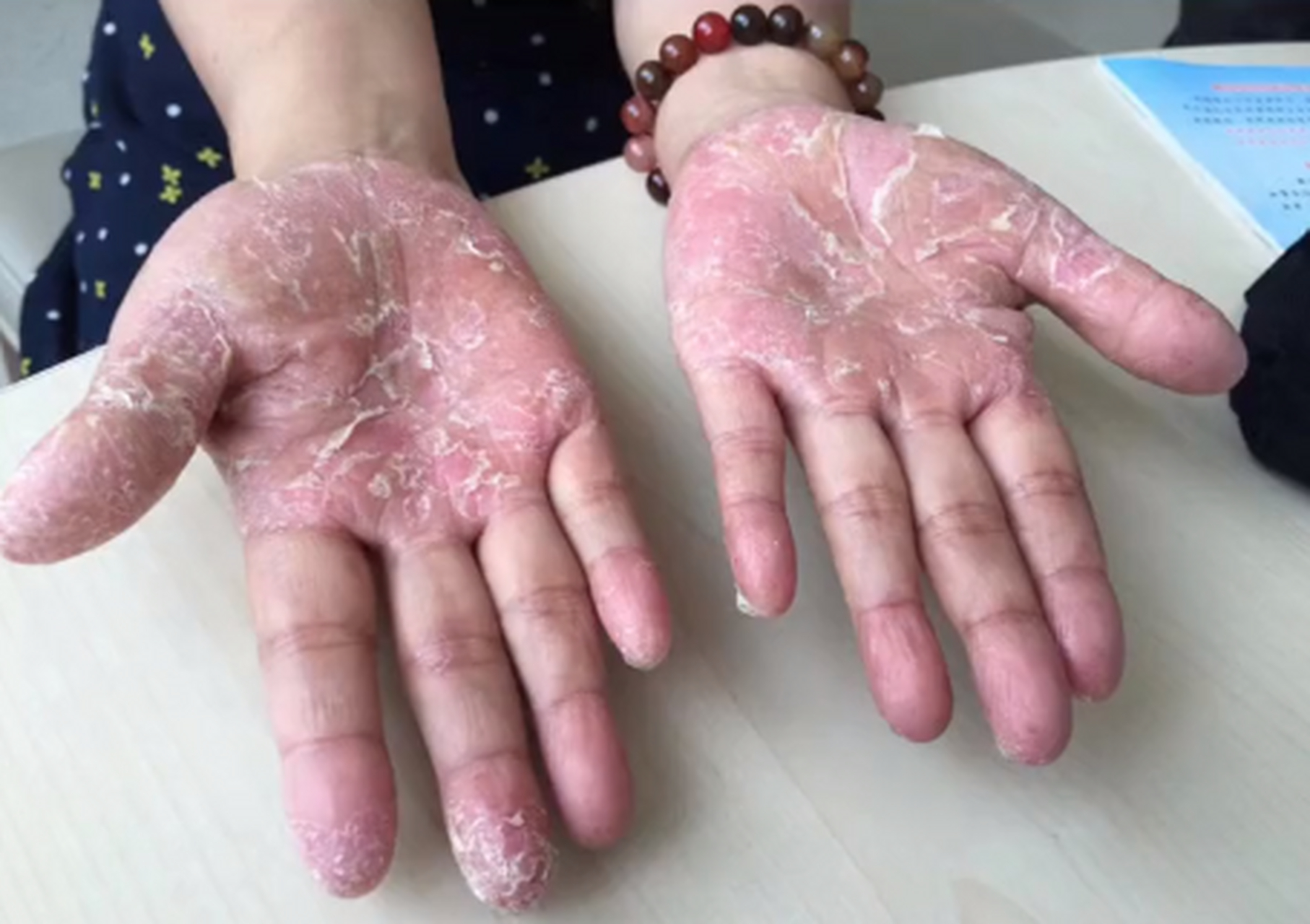 风湿免疫病#  掌跖脓疱病患者皮肤比较敏感,要注意饮食作息,日常苫铑