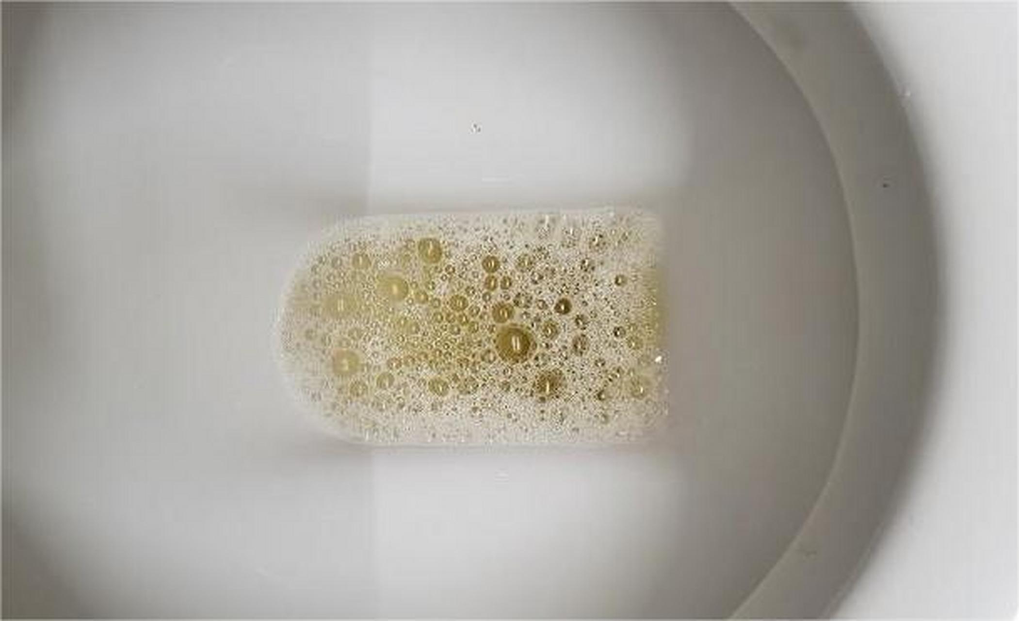 出现泡沫尿,还可能是这3种疾病的信号! 1.