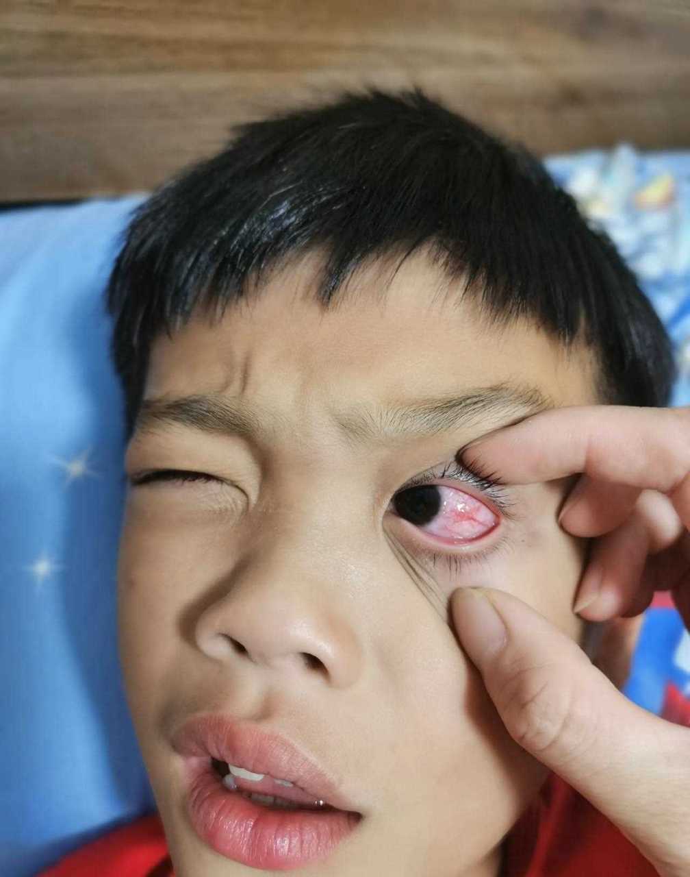 我家大宝的左眼睛那两天突然就红了,刚开始两三天我没在意,以为过两三