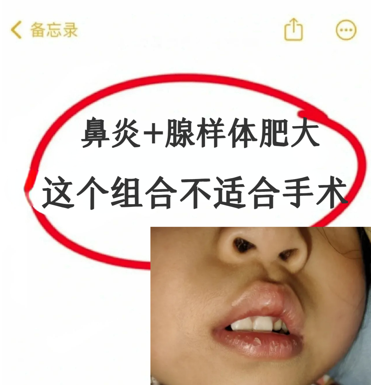 伴有鼻炎的腺样体肥大,我劝你别给孩子一刀切!