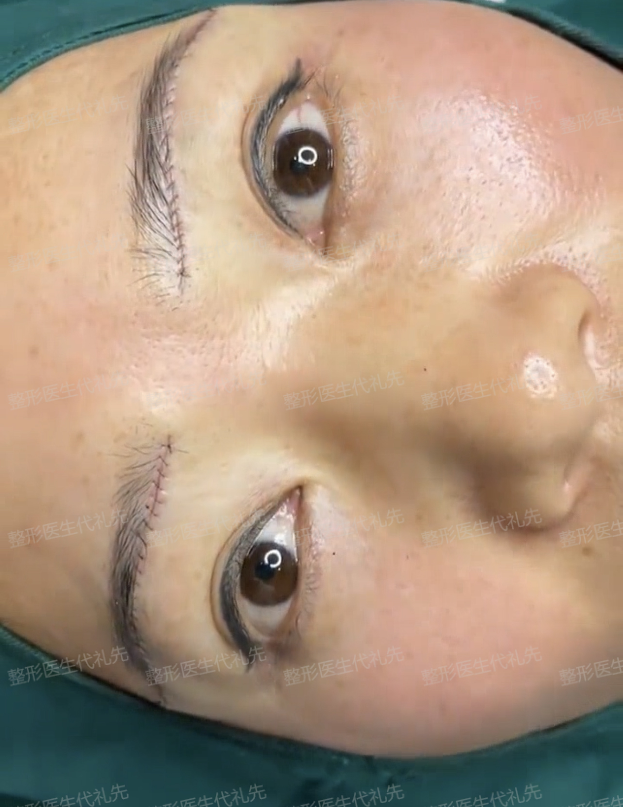 有一部分求美者在术前很担心做提眉手术会切掉一部分眉毛没有了