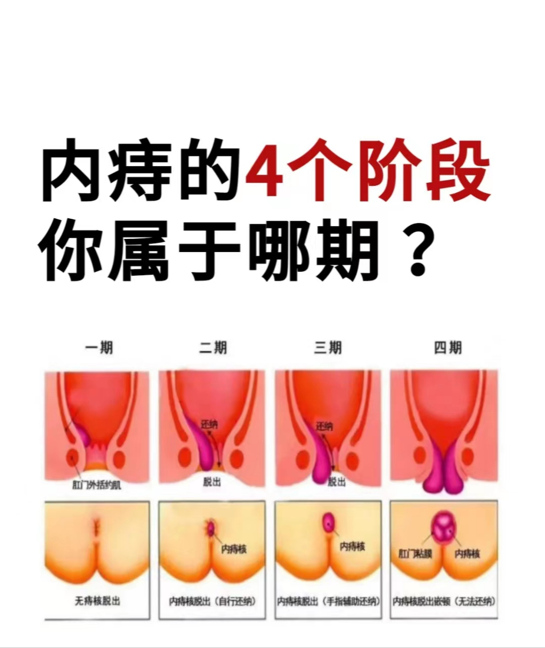 内痔是一种比较常见的痔疮,它位于齿状线以上,是曲张的静脉血管团