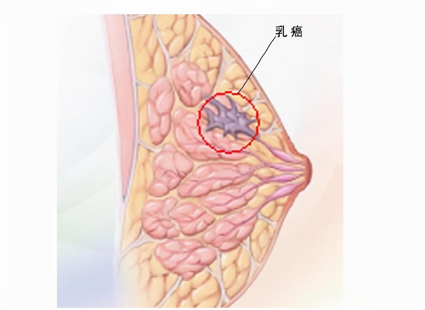 乳腺结节是什么样子图片