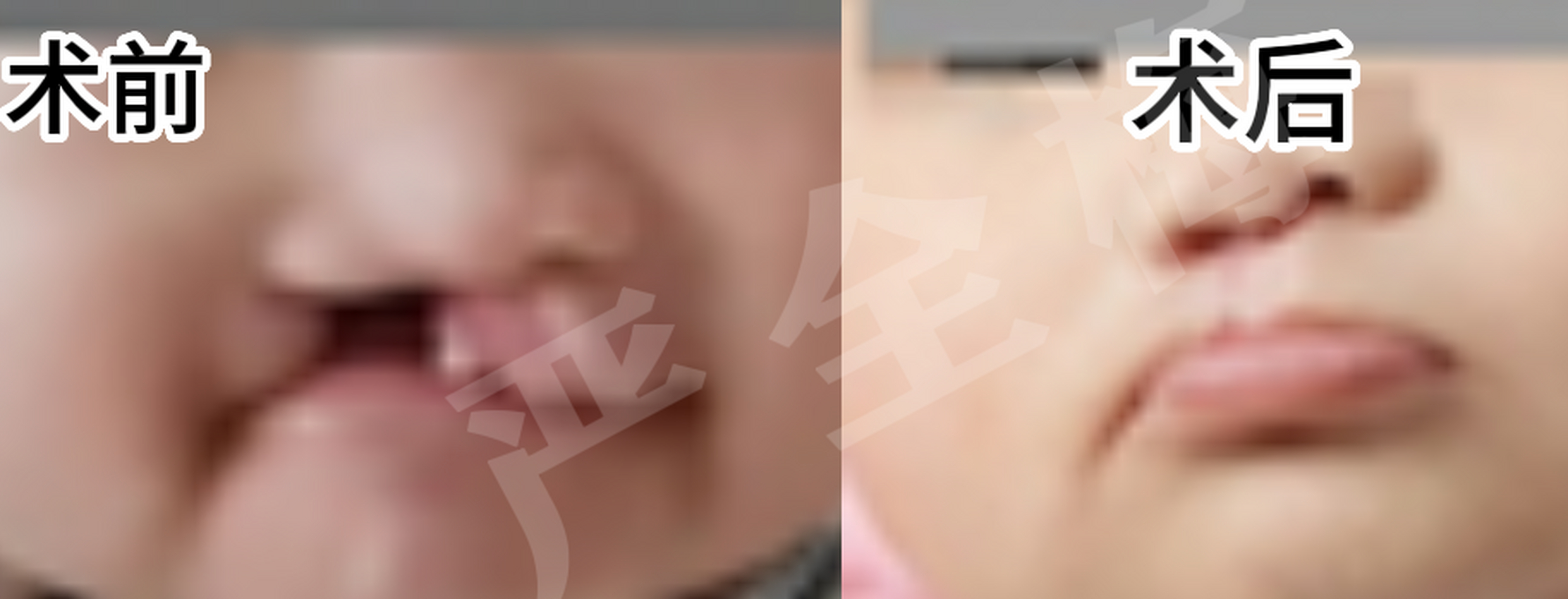 男  2岁  3度唇腭裂患者 妈妈:主任麻烦您看看我孩子,不想让他被同龄