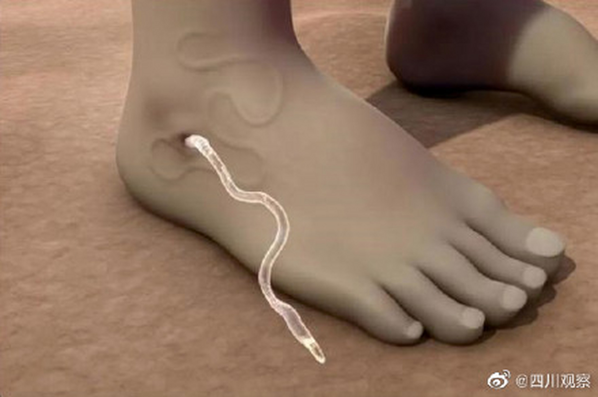 据了解,龙线虫俗称"几内亚虫".是能寄生在哺乳动物体深部的大型线虫.