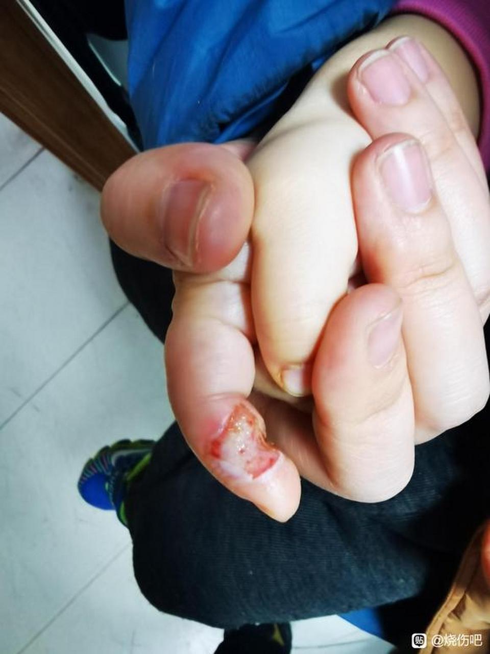 孩子右手食指三度烧伤小记 1#烧伤# #健康经验笔记# #疾病治疗经验