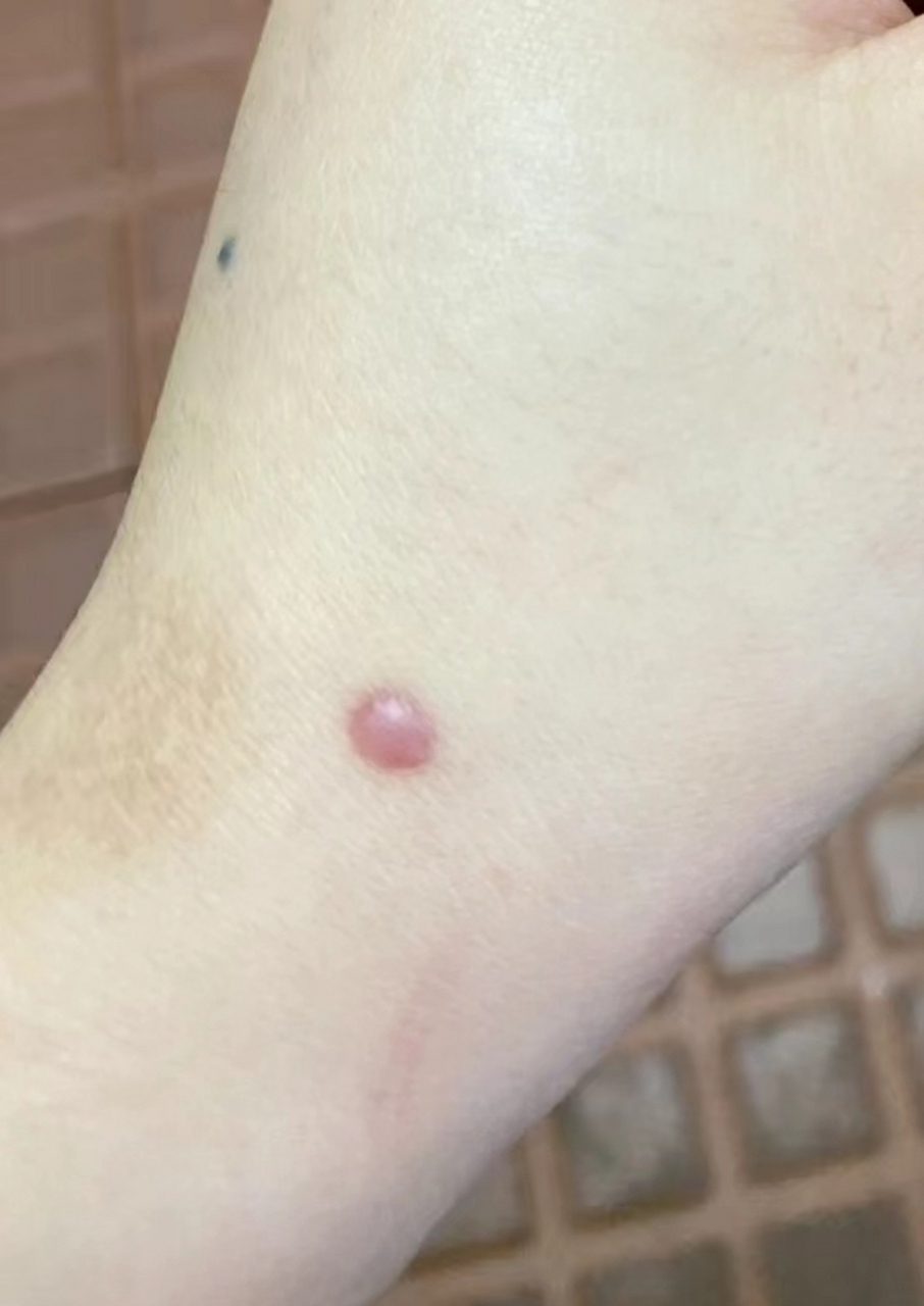 根据有无诱因及临床表现,主要可以分为常规疤痕,增生性疤痕,#疤痕