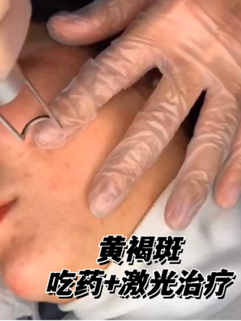 长黄褐斑都七八年了,吃药 激光治疗 我今年32岁,长黄褐斑都七八年了