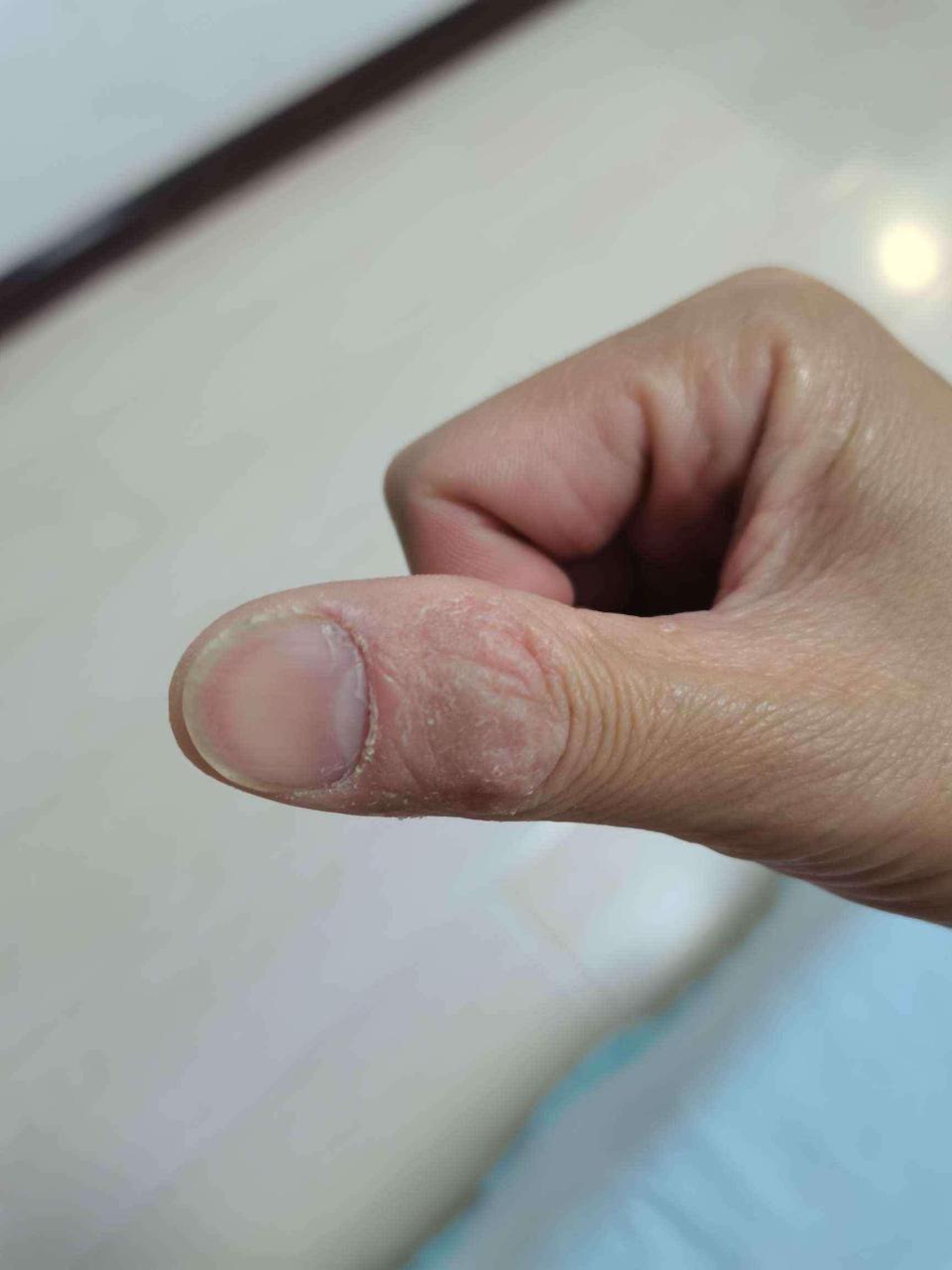 【患者提问】男,38岁,手指上起皮,干裂,不疼,不痒,是什么原因,麻烦给