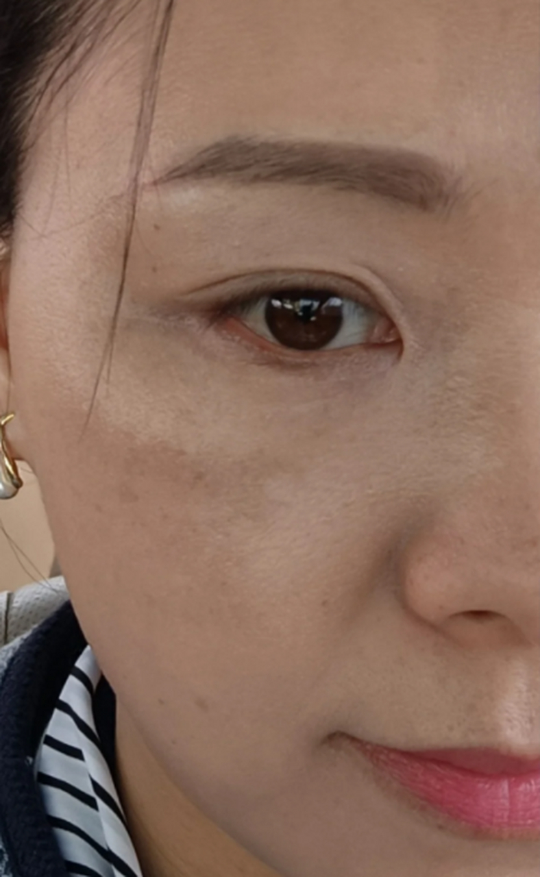 黄褐斑是皮肤色素沉淀过多,形成的一种斑点.