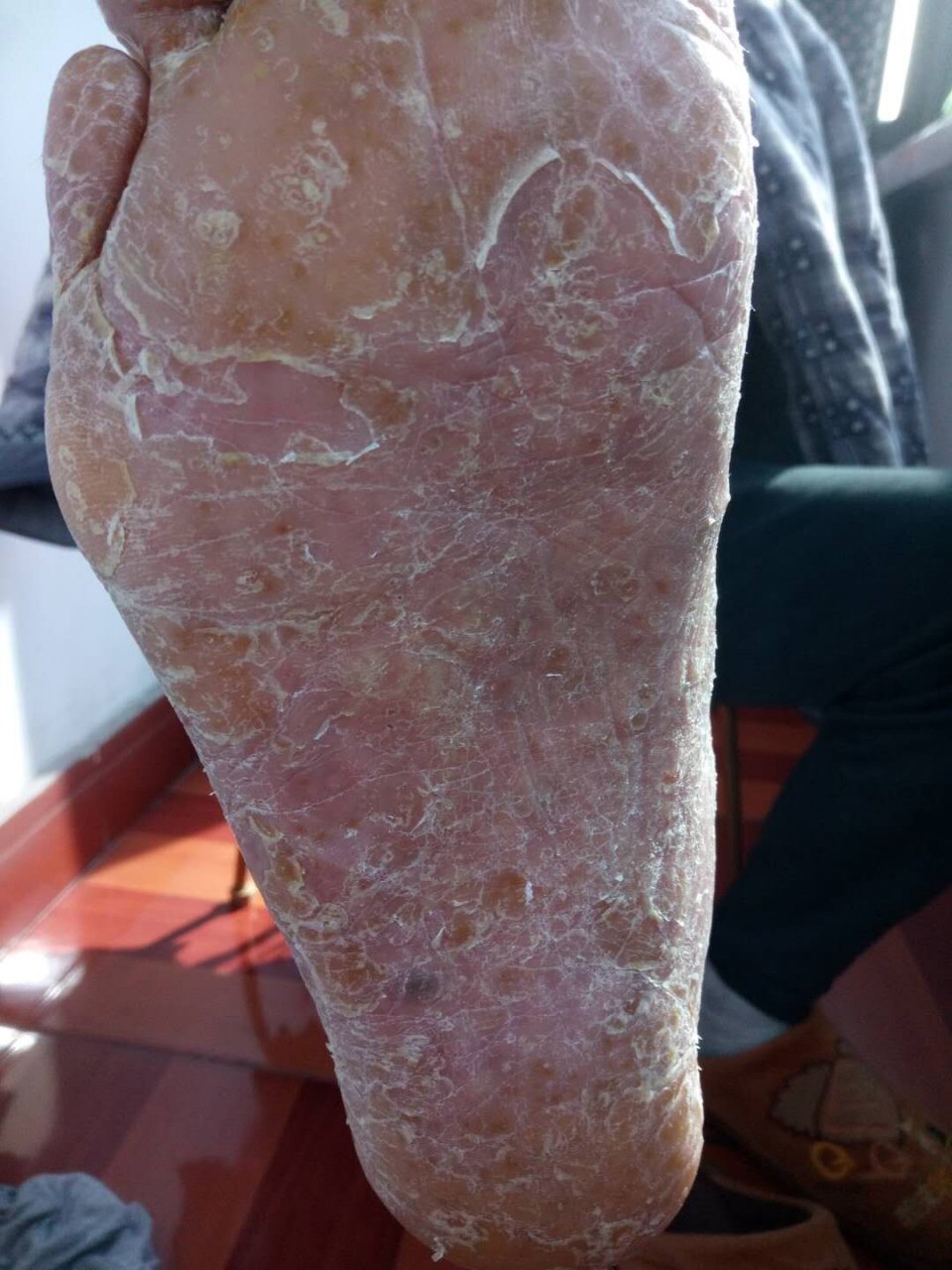 掌跖脓疱病,常与汗疱疹和手足癣相混淆.