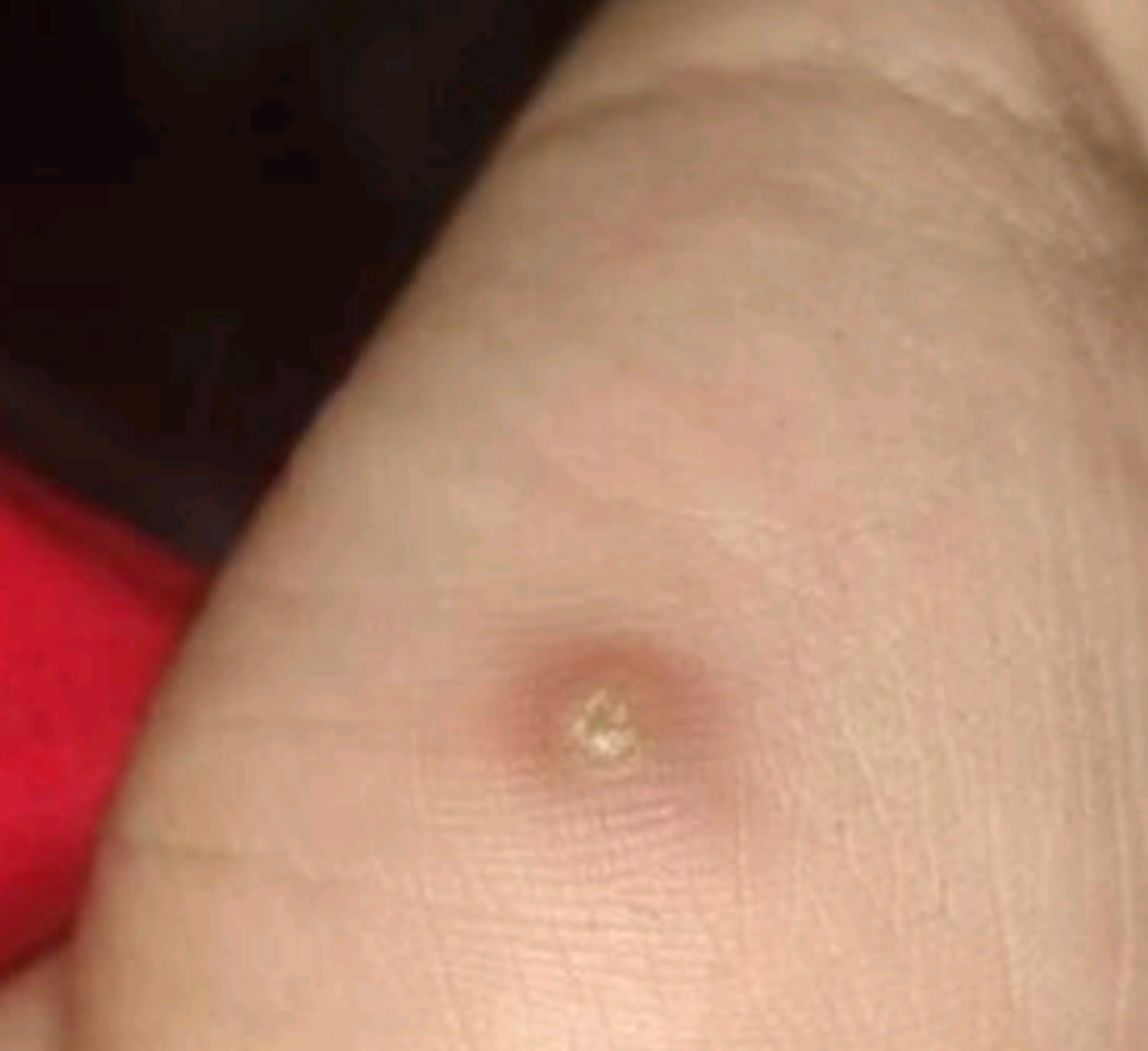 鸡眼不都是长在脚上的.