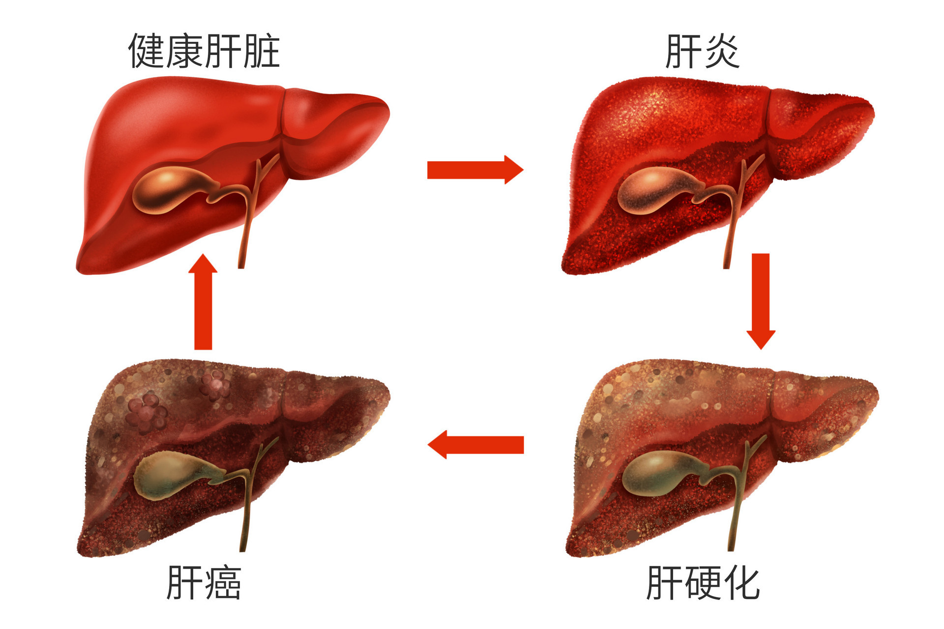 血吸虫性肝硬化图片