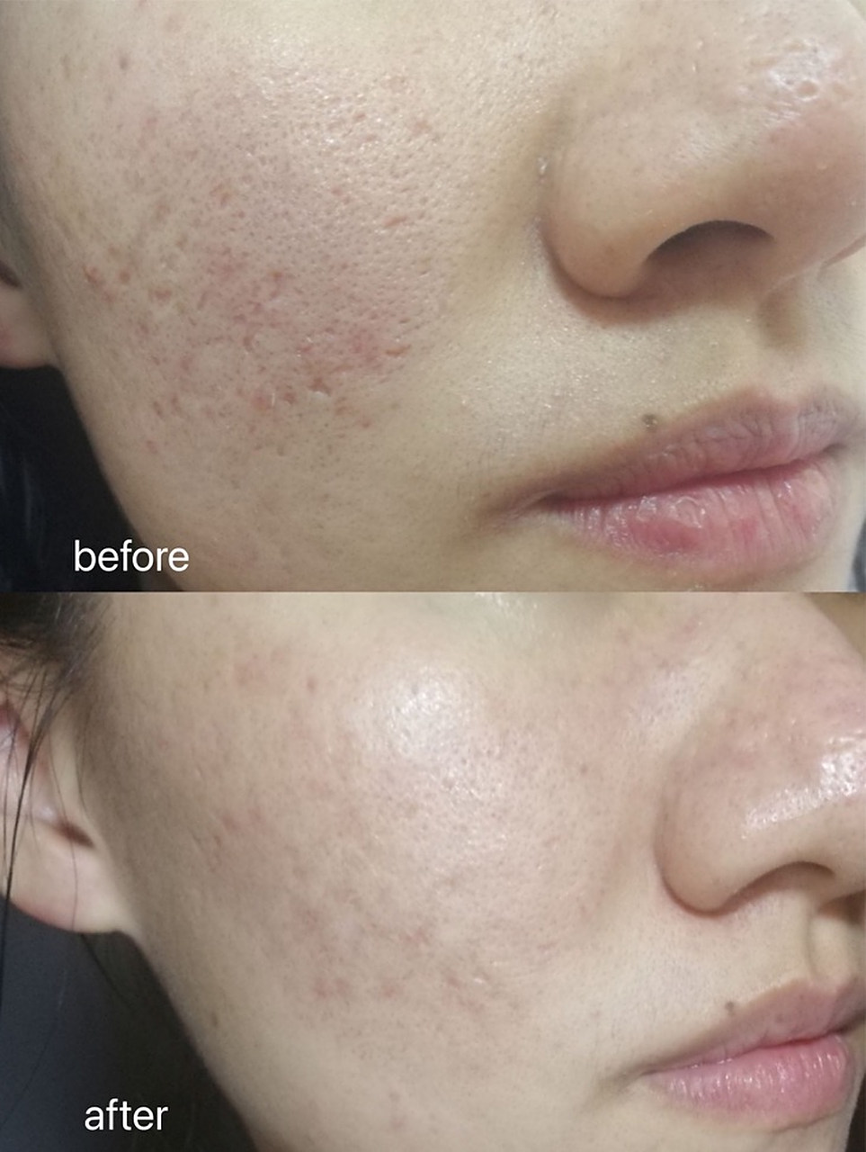 黑痘印是由于长期的痘痘不当处理而留下的色素沉淀,通常需要一定的