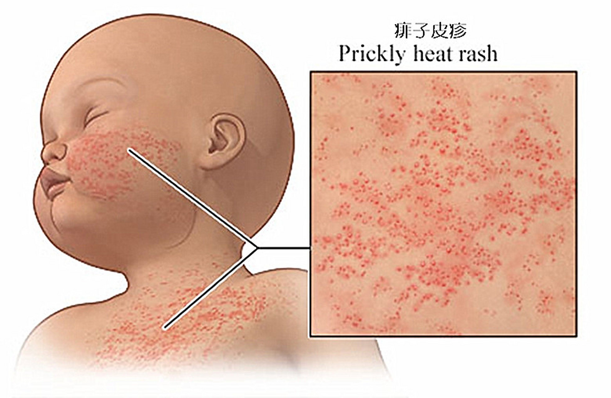 "医生,快给我家宝宝看看吧,这脖子,后背有大片的疹子,是不是过敏了啊