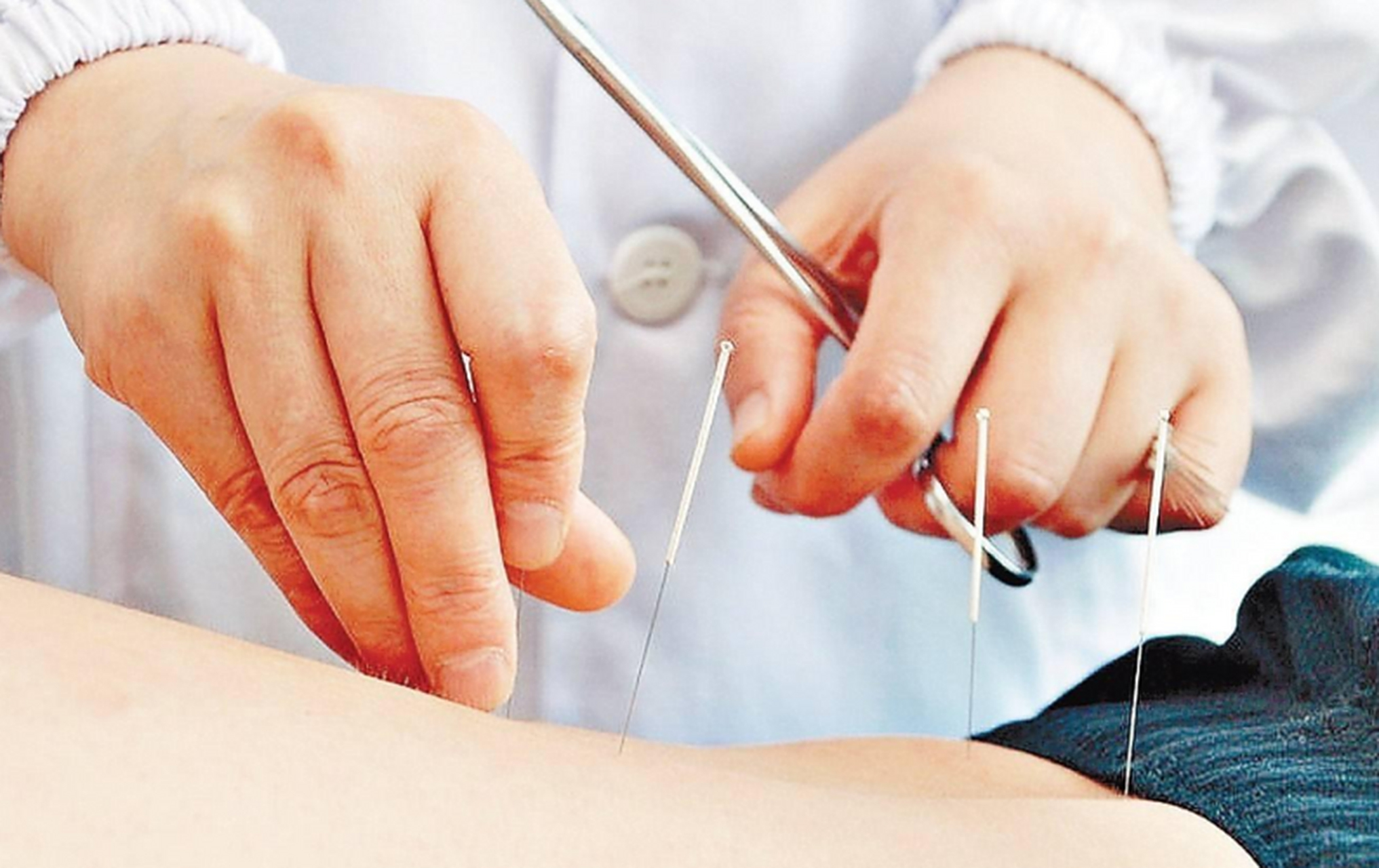 偏瘫一年半针灸治疗具有一定效果,可改善患者目前肢体活动不利的症状