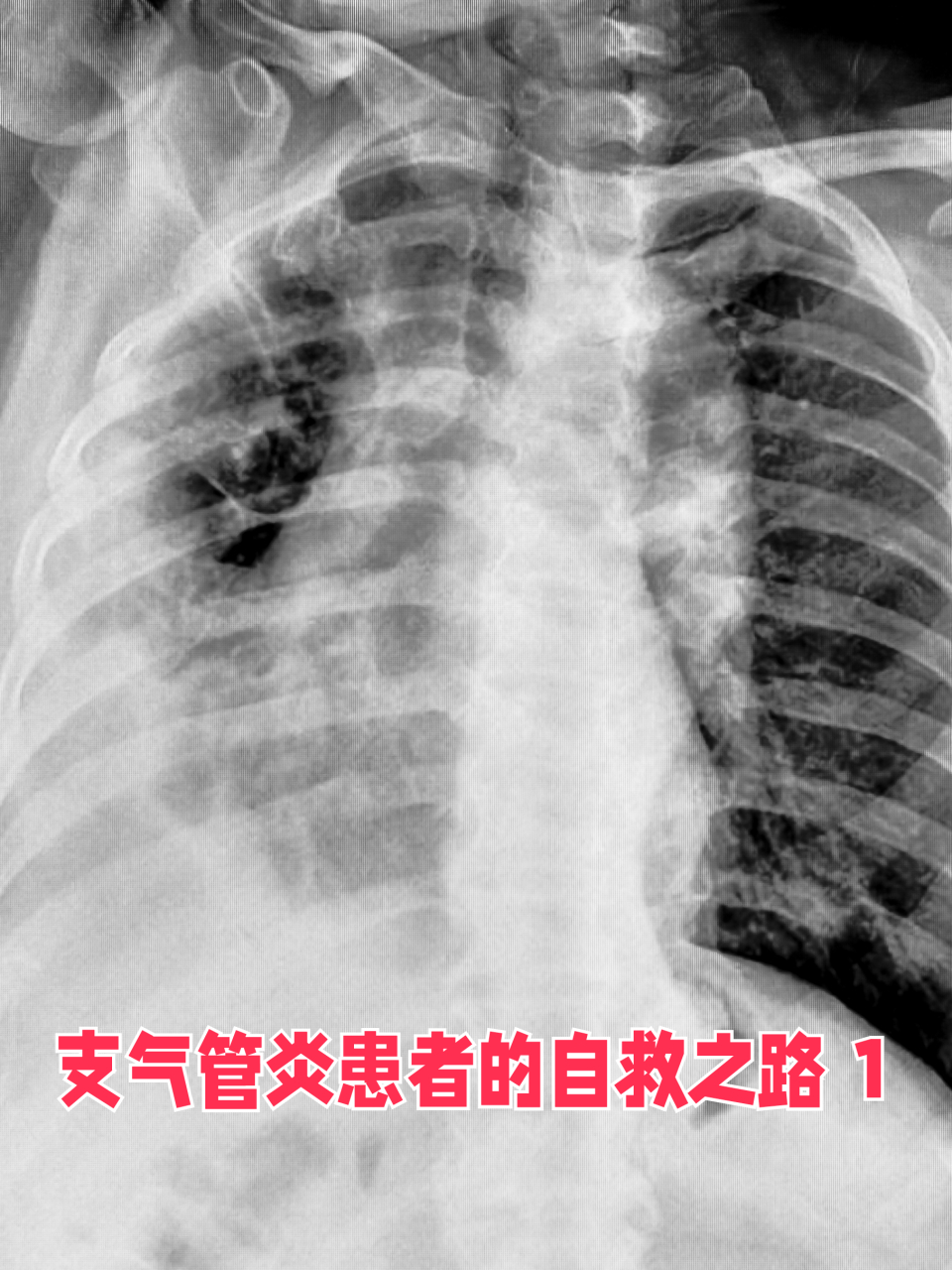 一个真实的支气管炎患者的自救之路   1 我很清楚记得2014年我得了支