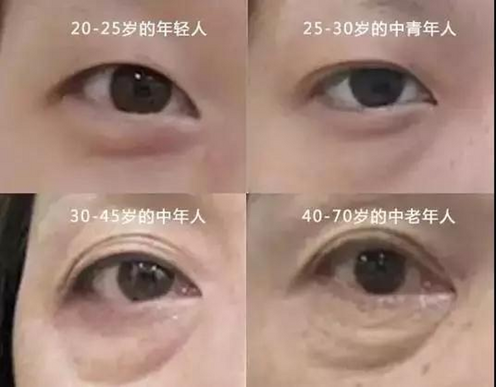 20—25年轻人:常见单纯眼轮匝肌肥厚型眼袋,突出特点是