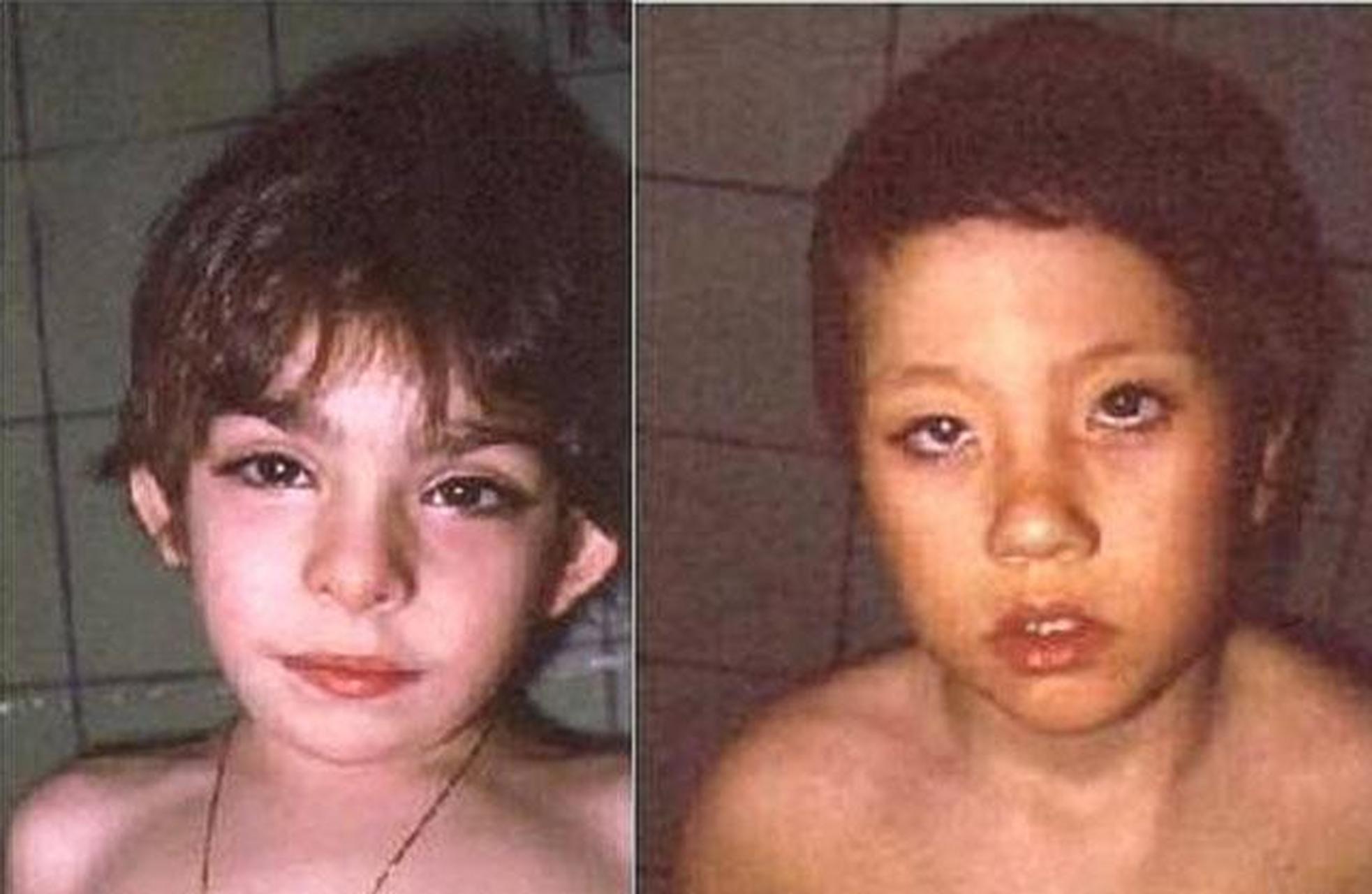 [疑问]】  "歌舞伎面谱综合征",也叫做化妆综合症,kabuki综合征,大