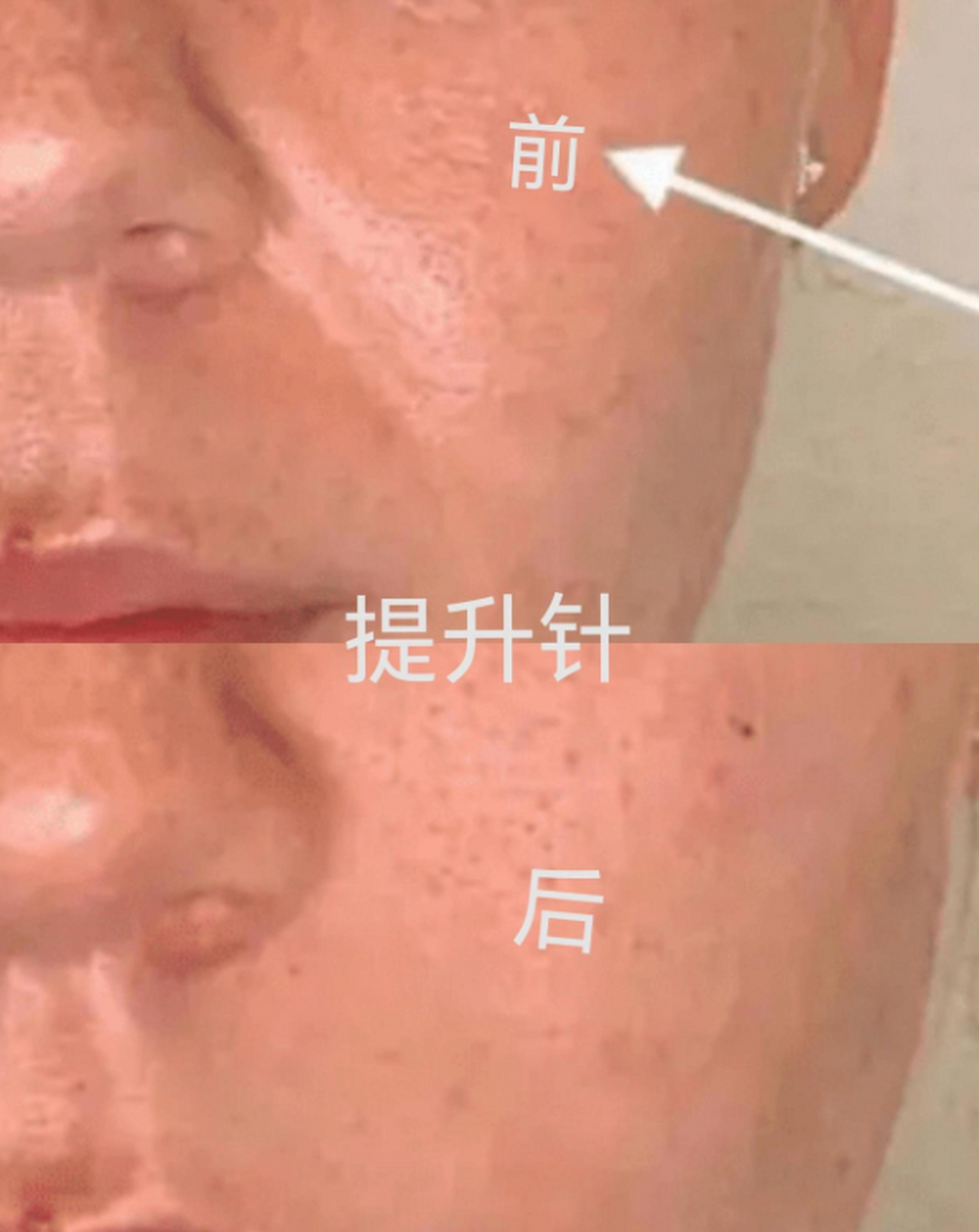 效果需要因人而异,每个人的基础状态不一样,打完提升针的效果也会有