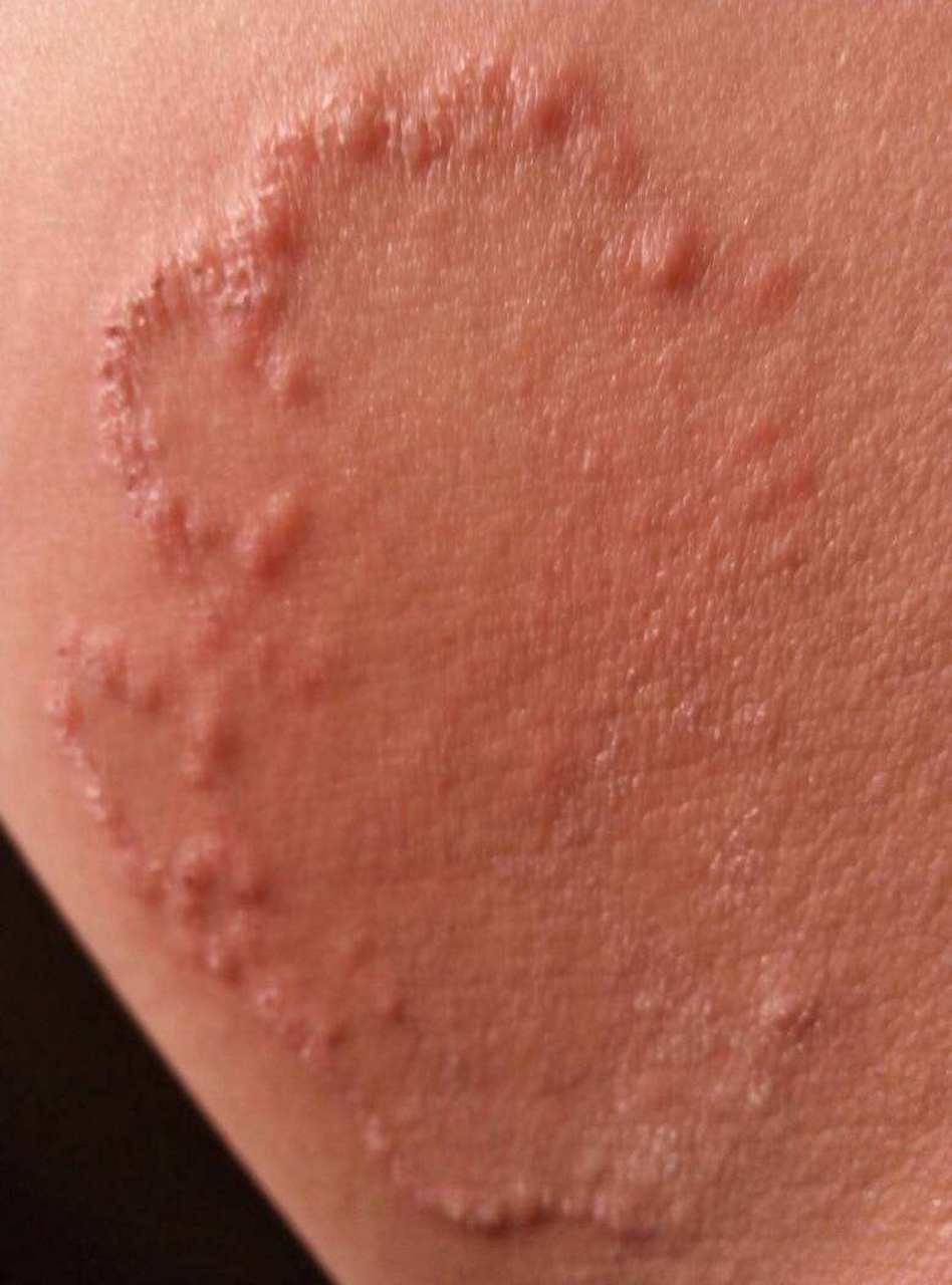 大腿内侧出现小丘疹,特别痒可以这样处理 大腿内侧出现一些环形,红色